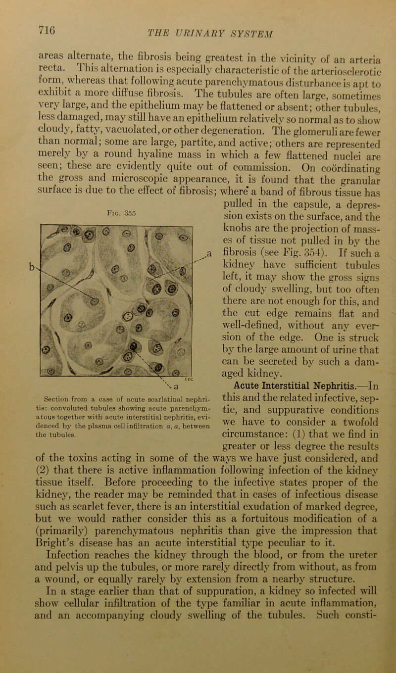 71G areas alternate, tlie fibrosis being greatest in the vicinity of an arteria recta, ibis alternation is especially characteristic of the arteriosclerotic form, whereas that following acute parenchymatous disturbance is apt to exhibit a more diffuse fibrosis. The tubules are often large, sometimes very large, and the epithelium may be flattened or absent; other tubules, less damaged, may still have an epithelium relatively so normal as to show cloudy, fatty, vacuolated, or other degeneration. The glomeruli are fewer than normal; some are large, partite, and active; others are represented merely by a round hyaline mass in which a few flattened nuclei are seen, these are evidently quite out of commission. On coordinating the gross and microscopic appearance, it is found that the granular surface is due to the effect of fibrosis; where* a band of fibrous tissue has pulled in the capsule, a depres- sion exists on the surface, and the knobs are the projection of mass- es of tissue not pulled in by the fibrosis (see Fig. 354). If such a kidney have sufficient tubules left, it may show the gross signs of cloudy swelling, but too often there are not enough for this, and the cut edge remains flat and well-defined, without any ever- sion of the edge. One is struck by the large amount of urine that can be secreted by such a dam- aged kidney. Acute Interstitial Nephritis.—In this and the related infective, sep- tic, and suppurative conditions we have to consider a twofold circumstance: (1) that we find in greater or less degree the results of the toxins acting in some of the ways we have just considered, and (2) that there is active inflammation following infection of the kidney tissue itself. Before proceeding to the infective states proper of the kidney, the reader may be reminded that in cas'es of infectious disease such as scarlet fever, there is an interstitial exudation of marked degree, but we would rather consider this as a fortuitous modiflcation of a (primarily) parenchymatous nephritis than give the impression that Bright’s disease has an acute interstitial type peculiar to it. Infection reaches the kidney through the blood, or from the ureter and pelvis up the tubules, or more rarely directly from without, as from a wound, or equally rarely by extension from a nearby structure. In a stage earlier than that of suppuration, a kidney so infected will show cellular infiltration of the type familiar in acute inflammation, and an accompanying cloudy swelling of the tubules. Such consti- Fig. 355 Section from a case of acute scarlatinal nephri- tis: convoluted tubules showing acute parenchym- atous together with acute interstitial nephritis, evi- denced by the plasma cell infiltration o, a, between the tubules.