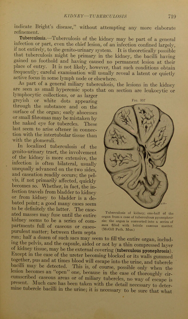 Fig. 357 indicate Bright’s disease,” without attempting any more elaborate refinement. Tuberculosis.—Tuberculosis of the kidney may be part of a general infection or part, even the chief lesion, of an infection confined largel}^, if not entirely, to the genito-urinary system. It is theoretically possible that tuberculosis might be primary in the kidney, the bacilli having gained no foothold and having caused no permanent lesion at their place of entry. It is not likely, however, that such conditions obtain frequentl}''; careful examination will usually reveal a latent or quietly active focus in some lymph node or elsewhere. As part of a general miliary tuberculosis, the lesions in the kidney are seen as small hyperemic spots that on section are leukocytic or lymphocytic collections, or as larger greyish or white dots appearing through the substance and on the surface of the organ; early abscesses or small fibromas may be mistaken by the naked eye for tubercles. These last seem to arise oftener in connec- tion with the intertubular tissue than with the glomeruli. In localized tuberculosis of the genito-urinary tract, the involvement of the kidney is more extensive, the infection is often bilateral, usually unequally advanced on the two sides, and caseation readily occurs; the pel- vis, if not primarily affected, quickly becomes so. Whether, in fact, the in- fection travels from bladder to kidney or from kidney to bladder is a de- bated point; a good many cases seem to be definitely the latter. The case- ated masses may fuse until the entire kidney seems to be a series of com- partments full of caseous or caseo- purulent matter; between them septa run; half a dozen of such sacs may seem to fill the entire organ, includ- ing the pelvis, and the capsule, aided or not by a thin compressed layer of kidney tissue, may be the external covering (tuberculous pyonephrosis), kxcept m the case of the ureter becoming blocked or its walls gummed together, pus and at times blood will escape into the urine, and tubercle bacilh may be detected. This is, of course, possible only when the lesion becomes an “open” one, because in the case of thoroughly cir- cumscribed caseous areas or of miliary tubercles, no way of escape is present. Much care has been taken with the detail necessary to deter- mine tubercle bacilli in the urine; it is necessary to be sure that what Tuberculosis of kidney; one-half of the organ from a case of tuberculous pyonephro- sis; the organ is converted into a series of sacs filled with brittle caseous matter. (McGill Path. Mus.)