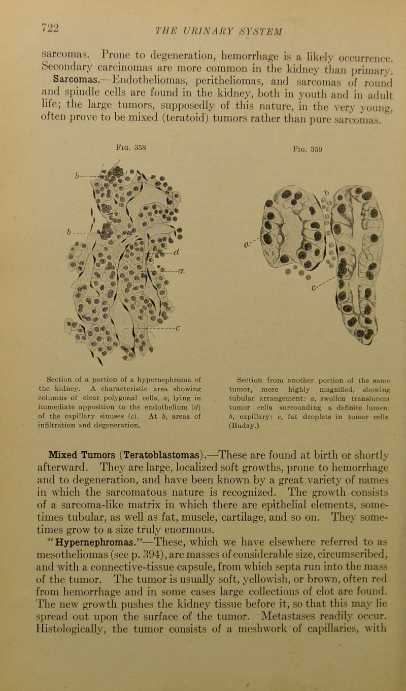 790 sarcomas. Prone to degeneration, hemorrliage is a likely occurrence. Secondary carcinomas are more common in the kidney than i)rimary. Sarcomas.—Endotheliomas, peritheliomas, and sarcomas of round and spindle cells are found in the kidney, both in youth and in adult life; the large tumors, supposedly of this nature, in the very young, often prove to be mixed (teratoid) tumors rather than pure sarcomas. Fia. 358 Section of a portion of a hypernephroma of the kidney. A characteristic area showing columns of clear polygonal cells, a, lying in immediate apposition to the endothelium (d) of the capillary sinuses (c). At b, areas of inSltration and degeneration. Fig. 359 Section from another portion of the same tumor, more highly magnified, showing tubular arrangement: a, swollen translucent tumor cells surrounding a definite lumen. b, capillary: c, fat droplets in tumor cells. (Buday.) Mixed Tumors (Teratoblastomas).—These are found at birth or shortly afterward. They are large, localized soft growths, prone to hemorrhage and to degeneration, and have been known by a great.variety of names in which the sarcomatous nature is recognized. The growth consists of a sarcoma-like matrix in which there are epithelial elements, some- times tubular, as well as fat, muscle, cartilage, and so on. They some- times grow to a size truly enormous. “Hypernephromas.”—These, which we have elsewhere referred to as mesotheliomas (see p. 394), are masses of considerable size, circumscribed, and with a connective-tissue capsule, from which septa run into the mass of the tumor. The tumor is usually soft, yellowish, or brown, often red from hemorrhage and in some cases large collections of clot are found. The new growth pushes the kidney tissue before it, so that this may lie spread out upon the surface of the tumor. Metastases readily occur. Histologically, the tumor consists of a meshwork of capillaries, with
