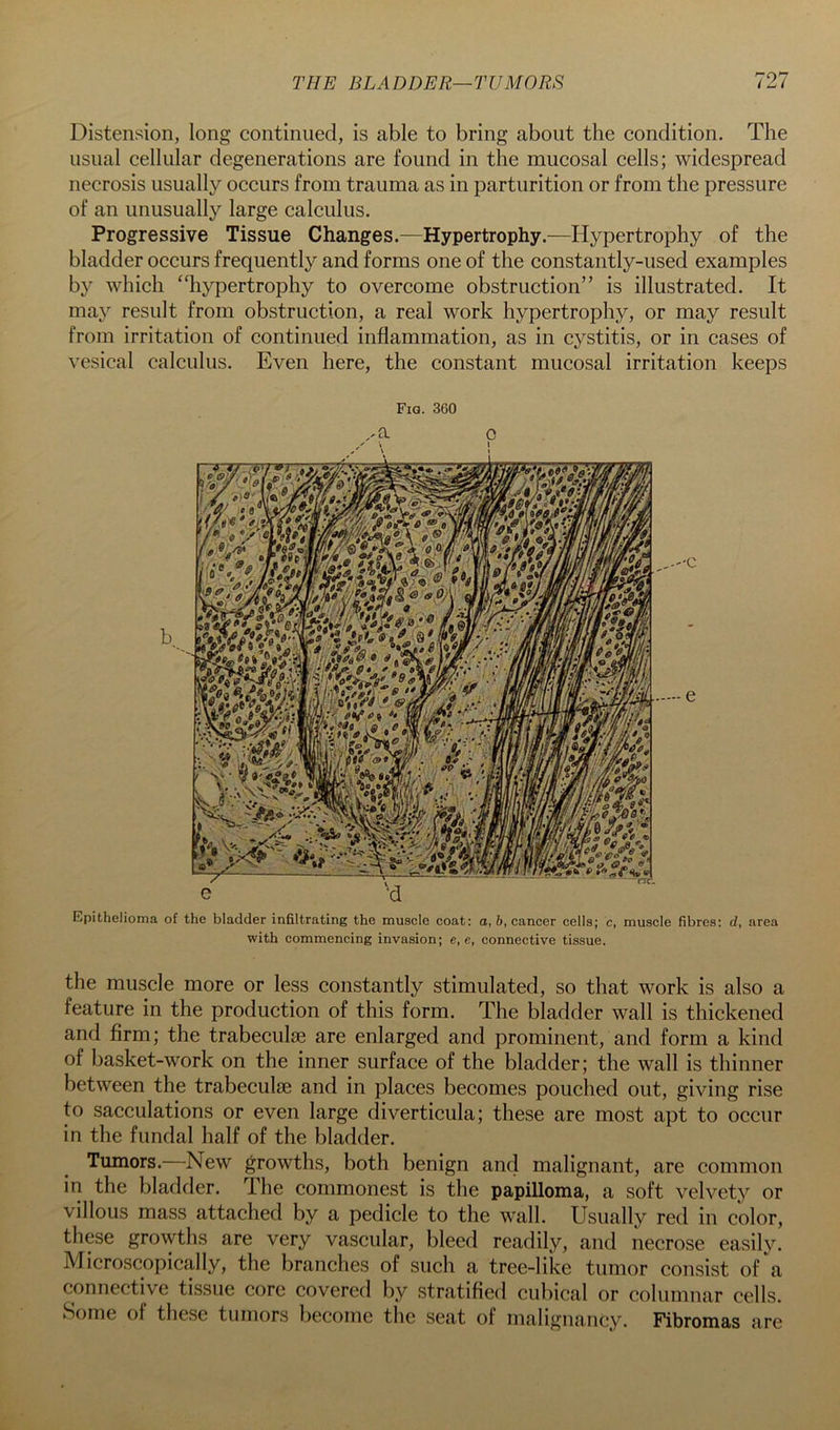 Distension, long continued, is able to bring about the condition. The usual cellular degenerations are found in the mucosal cells; widespread necrosis usually occurs from trauma as in parturition or from the pressure of an unusually large calculus. Progressive Tissue Changes.—Hypertrophy.—Hypertrophy of the bladder occurs frequently and forms one of the constantly-used examples by which ‘‘hypertrophy to overcome obstruction” is illustrated. It may result from obstruction, a real work hypertrophy, or may result from irritation of continued inflammation, as in cystitis, or in cases of vesical calculus. Even here, the constant mucosal irritation keeps Fiq. 360 Epithelioma of the bladder infiltrating the muscle coat: a, &, cancer cells; c, muscle fibres: d, area with commencing invasion; e, e, connective tissue. the muscle more or less constantly stimulated, so that work is also a feature in the production of this form. The bladder wall is thickened and firm; the trabeculae are enlarged and prominent, and form a kind of basket-work on the inner surface of the bladder; the wall is thinner between the trabeculae and in places becomes pouched out, giving rise to sacculations or even large diverticula; these are most apt to occur in the fundal half of the bladder. Tumors.—New growths, both benign and malignant, are common in the bladder. The commonest is the papilloma, a soft velvety or villous mass attached by a pedicle to the wall. Usually red in color, these growths are very vascular, bleed readily, and necrose easily. Microscopically, the branches of such a tree-like tumor consist of a connective tissue core covered by stratified cubical or columnar cells. Some of these tumors become the seat of malignancy. Fibromas are