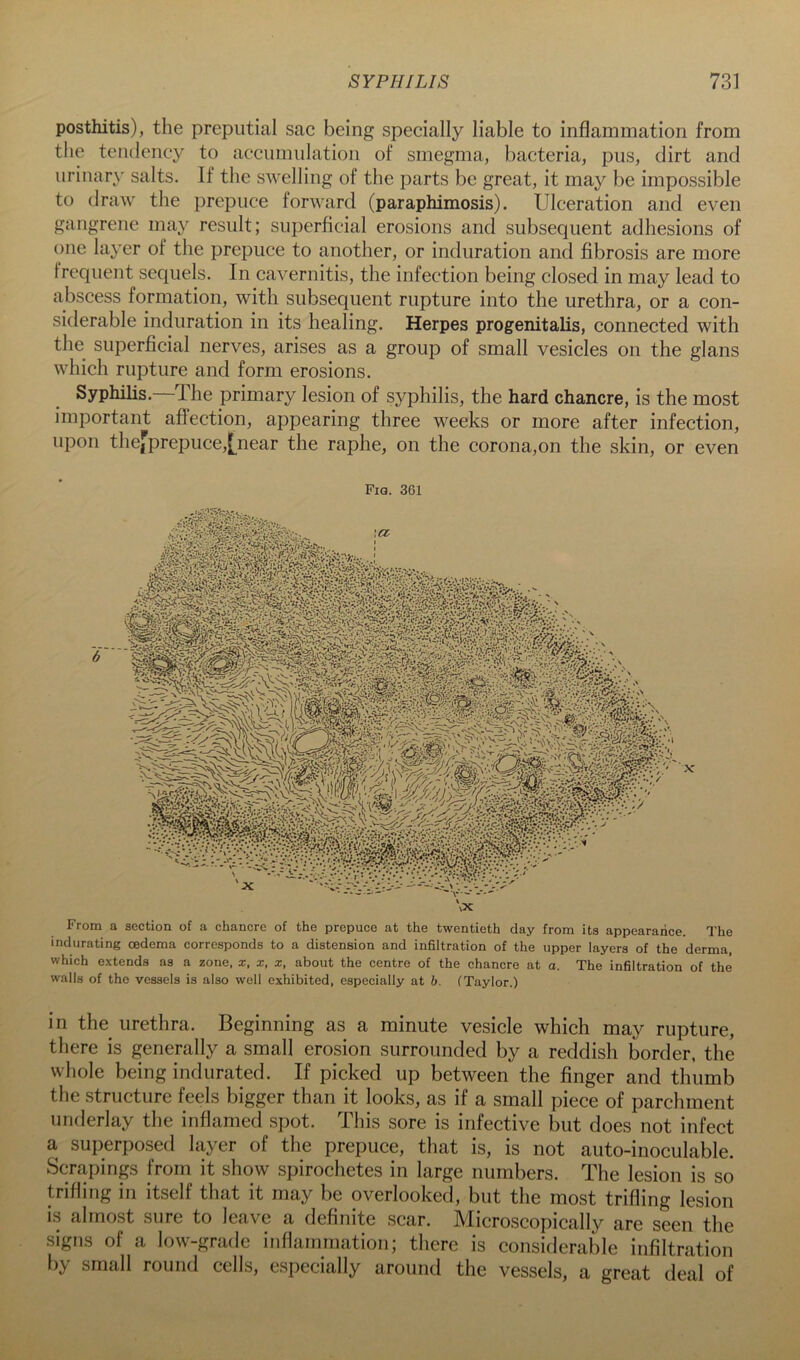 posthitis), the preputial sac being specially liable to inflammation from the tendency to accumulation of smegma, bacteria, pus, dirt and iirinar}' salts. If the swelling of the parts be great, it may be impossible to draw the prepuce forward (paraphimosis). Ulceration and even gangrene may result; superficial erosions and subsequent adhesions of one layer of the prepuce to another, or induration and fibrosis are more frequent sequels. In cavernitis, the infection being closed in may lead to abscess formation, with subsequent rupture into the urethra, or a con- siderable induration in its healing. Herpes progenitalis, connected with the superficial nerves, arises as a group of small vesicles on the glans which rupture and form erosions. Syphilis.—The primary lesion of syphilis, the hard chancre, is the most important afl'ection, appearing three weeks or more after infection, upon thefprepuce,[^near the raphe, on the corona,on the skin, or even Fia. 361 From a section of a chancre of the prepuce at the twentieth day from its appearaiice. The indurating oedema corresponds to a distension and infiltration of the upper layers of the derma, which extends as a zone, x, x, x, about the centre of the ehancre at a. The infiltration of the walls of the vessels is also well exhibited, especially at b. (Taylor.) in the urethra. Beginning as a minute vesicle which may rupture, there is generally a small erosion surrounded by a reddish border, the whole being indurated. If picked up between the finger and thumb the structure feels bigger than it looks, as if a small piece of parchment underlay the inflamed spot. This sore is infective but does not infect a superposed layer of the prepuce, that is, is not auto-inoculable. Scrapings from it show spirochetes in large numbers. The lesion is so trifling in itself that it may be overlooked, but the most trifling lesion is almost sure to leave a definite scar. Microscopically are seen the signs of a low-grade inflainmation; there is considerable infiltration by small round cells, especially around the vessels, a great deal of