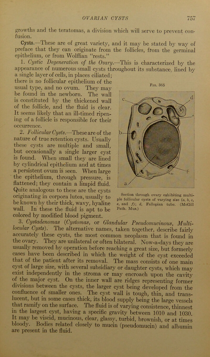 Fig. 365 »Tovvths and the teratomas, a division which will serve to prevent con- fusion. Cysts. These are of great variety, and it may be stated by way of preface that they can originate from the follicles, ffom the germinal epithelium, or from Wolffian ‘bests.” 1. Cystic Degeneration of the Ovary.—This is characterized by the appearance of numerous small cysts throughout its substance, lined by a single layer of cells, in places ciliated; there is no follicular epithelium of the usual type, and no ovum. They may be found in the newborn. The wall is constituted by the thickened wall of the follicle, and the fluid is clear. It seems likely that an ill-timed ripen- ing of a follicle is responsible for their occurrence. 2. Follicular Cysts.—^These are of the nature of true retention cysts. Usually these cysts are multiple and small, but occasionally a single larger cyst is found. When small they are lined by cylindrical epithelium and at times a persistent ovum is seen. When large ■ the epithelium, through pressure, is flattened; they contain a limpid fluid. Quite analogous to these are the cysts originating in corpora lutea, usually to be known by their thick, wavy, hyaline wall. In these the fluid is apt to be colored by modified blood pigment. 3. Cystadenomas {Cystomas, or Glandular Pseudomucinous, Multi- locular Cysts). The alternative names, taken together, describe fairly accurately these cysts, the most common neoplasm that is found in the ovary. They are unilateral or often bilateral. Now-a-days they are usually removed by operation before reaching a great size, but formerly cases have been described in which the weight of the cyst exceeded that of the patient after its removal. The mass consists of one main cyst of large size, with several subsidiary or daughter cysts, which may exist independently in the stroma or may encroach upon the cavity of the major cyst. On the inner wall are ridges representing former divisions between the cysts, the larger cyst being developed from the confluence of smaller ones. ^ The cyst wall is tough, thin, and trans- lucent, but in some cases thick, its blood supply being the large vessels that ramify on the surface. The fluid is of varying consistence, thinnest m the largest cyst, having a specific gravity between 1010 and 1030 It may be viscid, mucinous, clear, glassy, turbid, brownish, or at times bloody. Bodies related closely to mucin (pseudomucin) and albumin are present in the fluid. Section through ovary exhibiting multi- ple follicular cysts of varying size (a, b, c, e, and /); d, Fallopian tube. (McGill Path. Mus.)
