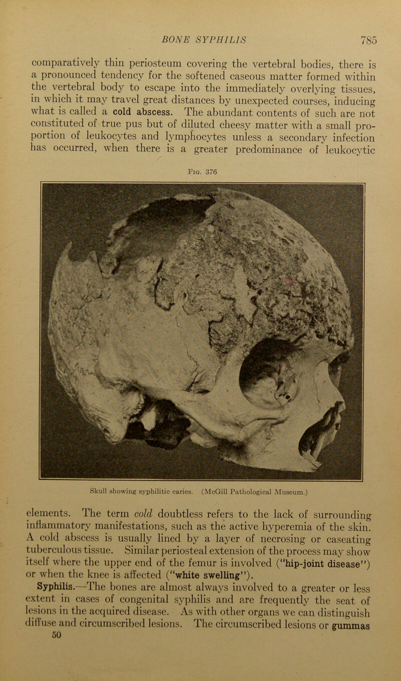 comparatively thin periosteum covering the vertebral bodies, there is a pronounced tendency for the softened caseous matter formed within the vertebral body to escape into the immediately overlying tissues, in which it may travel great distances by unexpected courses, inducing what is called a cold abscess. The abundant contents of such are not constituted of true pus but of diluted cheesy matter with a small pro- portion of leukocytes and lymphocytes unless a secondary infection has occurred, when there is a greater predominance of leukocytic Fig. 376 Skull showing syphilitic caries. (McGill Pathological Museum.) elements. The term cold doubtless refers to the lack of surrounding inflammatory manifestations, such as the active hyperemia of the skin. A cold abscess is usually lined by a layer of necrosing or caseating tuberculous tissue. Similar periosteal extension of the process may show itself where the upper end of the femur is involved (“Mp-joint disease”) or when the knee is affected (“white swelling”). Syphilis.—The bones are almost always involved to a greater or less extent in cases of congenital syphilis and are frequently the seat of lesions in the acquired disease. As witli otlier organs we can distinguish diffuse and circumscribed lesions. The circumscribed lesions or gummas 50