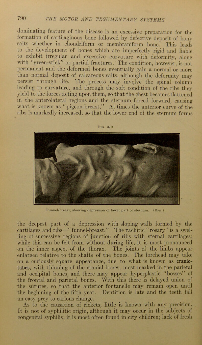 700 dominating feature of the disease is an excessive preparation for the formation of cartilaginous bone followed by defective deposit of bony salts whether in chondriform or membraniform bone. This lead's to the development of bones which are imperfectly rigid and liable to exhibit irregular and excessive curvature with deformity, along with “green-stick” or partial fractures. The condition, however, is not permanent and the deformed bones eventually gain a normal or more than normal deposit of calcareous salts, although the deformity may persist through life. The process may involve the spinal column leading to curvature, and through the soft condition of the ribs they yield to the forces acting upon them, so that the chest becomes flattened in the anterolateral regions and the sternum forced forward, causing what is known as “pigeon-breast,” At times the anterior curve of the ribs is markedly increased, so that the lower end of the sternum forms Fig. 379 Funnel-breast, showing depression of lower part of sternum. (Bier.) the deepest part of a depression with sloping walls formed by the cartilages and ribs—“funnel-breast.” The rachitic “rosary” is a swel- ling of successive regions of junction of ribs with sternal cartilages; while this can be felt from without during life, it is most pronounced on the inner aspect of the thorax. The joints of the limbs appear enlarged relative to the shafts of the bones. Tlie forehead may take on a curiously square appearance, due to what is known as cranio- tabes, with thinning of the cranial bones, most marked in the parietal and occipital bones, and there may appear hyperplastic “bosses” of the frontal and parietal bones. \Nith this there is delayed union of the sutures, so that the anterior fontanelle may remain open until the beginning of the fifth year. Dentition is late and the teeth fall an easy prey to carious change. As to the causation of rickets, little is known with any precision. It is not of syphilitic origin, although it may occur in the subjects of congenital syphilis; it is most often found in city children; lack of fresh