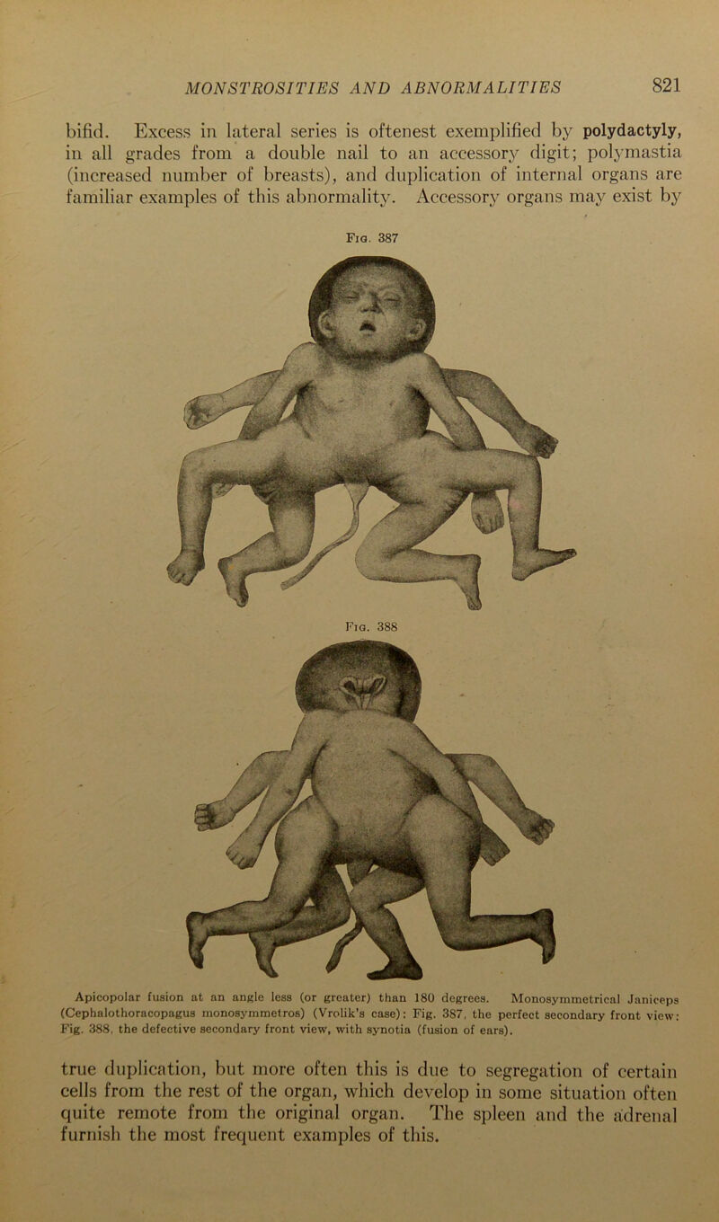 bifid. Excess in lateral series is oftenest exemplified by polydactyly, in all grades from a double nail to an accessory digit; polj’mastia (increased number of breasts), and duplication of internal organs are familiar examples of this abnormality. Accessory organs may exist by Fig. 387 Fig. 388 Apicopolar fusion at an angle less (or greater) than 180 degrees. Monosymmetrical Janiceps (Cephalothoracopagus monosymmetros) (Vrolik’s case): Fig. 387, the perfect secondary front view; Fig. 388, the defective secondary front view, with synotia (fusion of ears). true duplication, but more often this is due to segregation of certain cells from the rest of the organ, which develop in some situation often quite remote from the original organ. The spleen and the a:drenal furnish the most frequent examples of this.