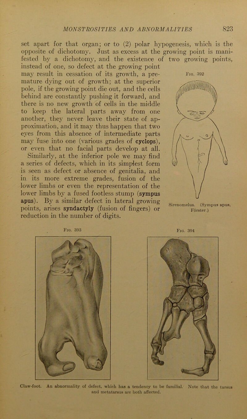 Claw-foot. An abnormality of defect, which ha.9 a tendency to bo familial. Note that the tarsus and metatarsus are both affected. MONSTROSITIES AND ABNORMALITIES Fig. 392 set apart for that organ; or to (2) polar hypogenesis, which is the opposite of dichotomy. Just as excess at the growing point is mani- fested by a dichotomy, and the existence of two growing points, instead of one, so defect at the growing point may result in cessation of its growth, a pre- mature dying out of growth; at the superior pole, if the growing point die out, and the cells behind are constantly pushing it forward, and there is no new growth of cells in the middle to keep the lateral parts away from one another, they never leave their state of ap- proximation, and it may thus happen that two eyes from this absence of intermediate parts may fuse into one (various grades of cyclops), or e^^en that no facial parts develop at all. Similarly, at the inferior pole we may find a series of defects, which in its simplest form is seen as defect or absence of genitalia, and in its more extreme grades, fusion of the lower limbs or even the representation of the lower limbs by a fused footless stump (sympus apus). B}'- a similar defect in lateral growing points, arises syndactyly (fusion of fingers) or reduction in the number of digits. Sirenomelus. (Sympus apus, Forster.) Fig. 393 Fig. 394