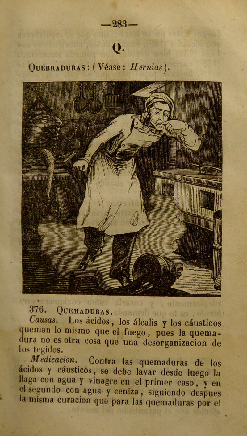 —283 — Q Quebraduras : ( Véase : Hernias ). 376. Qüemadüras. Causas. Los âcidos, los alcalis y los causticos queman lo mismo que el fuego, pues la quema- dura no es otra cosa que una desorganizacion de los tegidos. , .Médication. Contra las quemaduras de los âcidos y causticos, se debe lavar desde iuego la llaga con agua y vinagre en el primer caso, y en el segundo con agua y ceniza, siguiendo despues a misma curacion que para Jas quemaduras por el