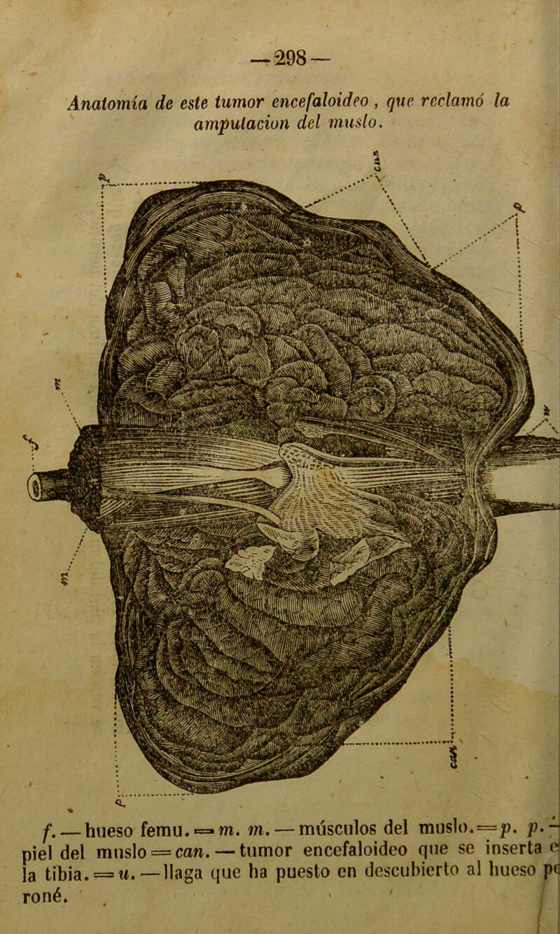 Anatornia de este tumor cncefaloideo, que réclamé la ampulacion del muslo. « f. — hueso femu.=»wi. m. — müsculos del muslo. ==p. p.~ piel del muslo = can. — tumor encefaloideo que se inserta <x la tibia. = u.—llaga que lia puesto en descubierto al hueso pc roné.