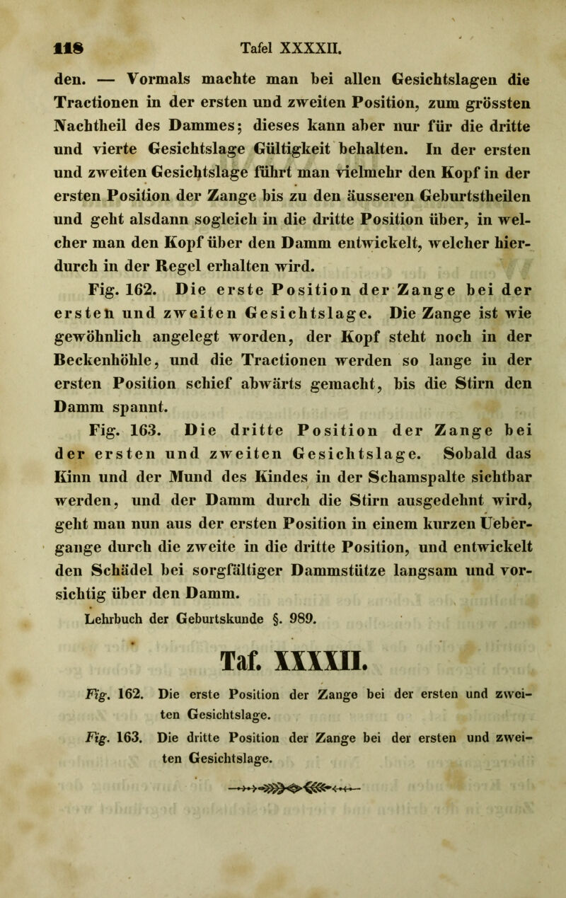 den. — Vormals machte man bei allen Gesichtslagen die Tractionen in der ersten und zweiten Position, zum grössten Nachtheil des Dammes; dieses kann aber nur für die dritte und vierte Gesichtslage Gültigkeit behalten. In der ersten und zweiten Gesichtslage führt man vielmehr den Kopf in der ersten Position der Zange bis zu den äusseren Geburtstheilen und geht alsdann sogleich in die dritte Position über, in wel- cher man den Kopf über den Damm entwickelt, welcher hier- durch in der Regel erhalten wird. Fig. 162. Die erste Position der Zange bei der ersteh und zweiten Gesichtslage. Die Zange ist wie gewöhnlich angelegt worden, der Kopf steht noch in der Beckenhöhle, und die Tractionen werden so lange in der ersten Position schief abwärts gemacht, bis die Stirn den Damm spannt. Fig. 163. Die dritte Position der Zange bei der ersten und zweiten Gesichtslage. Sobald das Kinn und der Mund des Kindes in der Schamspalte sichtbar werden, und der Damm durch die Stirn ausgedehnt wird, geht man nun aus der ersten Position in einem kurzen Ueber- gange durch die zweite in die dritte Position, und entwickelt den Schädel bei sorgfältiger Dammstütze langsam und vor- sichtig über den Damm. Lehrbuch der Geburtskunde §. 989. Taf. MWH. Fig. 162. Die erste Position der Zange bei der ersten und zwei- ten Gesichtslage. Fig. 163. Die dritte Position der Zange bei der ersten und zwei- ten Gesichtslage.