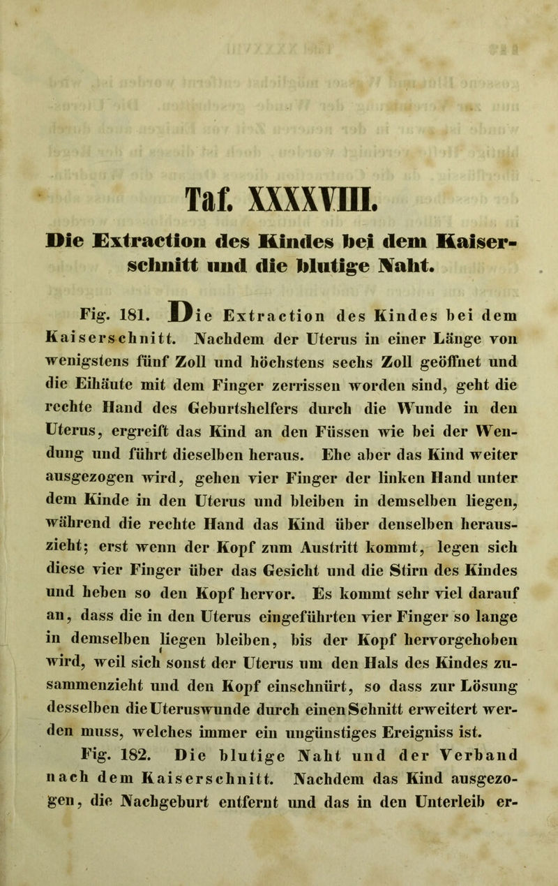 Die Extraction des Kindes liei dem Kaiser- schnitt und die blutige Mäht. Fig. 181. Die Extraction des Kindes bei dem Kaiserschnitt. Nachdem der Uterus in einer Länge von wenigstens fünf Zoll und höchstens sechs Zoll geöffnet und die Eihäute mit dem Finger zerrissen worden sind, geht die rechte Hand des Geburtshelfers durch die Wunde in den Uterus, ergreift das Kind an den Füssen wie bei der Wen- dung und führt dieselben heraus. Ehe aber das Kind weiter ausgezogen wird, gehen vier Finger der linken Hand unter dem Kinde in den Uterus und bleiben in demselben liegen, während die rechte Hand das Kind über denselben heraus- zieht; erst wenn der Kopf zum Austritt kommt, legen sich diese vier Finger über das Gesicht und die Stirn des Kindes und heben so den Kopf hervor. Es kommt sehr viel darauf an, dass die in den Uterus eingeführten vier Finger so lange in demselben liegen bleiben, bis der Kopf hervorgehoben wird, weil sich sonst der Uterus um den Hals des Kindes zu- sammenzieht und den Kopf einschnürt, so dass zur Lösung desselben die Uteruswunde durch einen Schnitt erweitert wer- den muss, welches immer ein ungünstiges Ereigniss ist. Fig. 182. Die blutige Naht und der Verband nach dem Kaiserschnitt. Nachdem das Kind ausgezo- gen, die Nachgeburt entfernt und das in den Unterleib er-