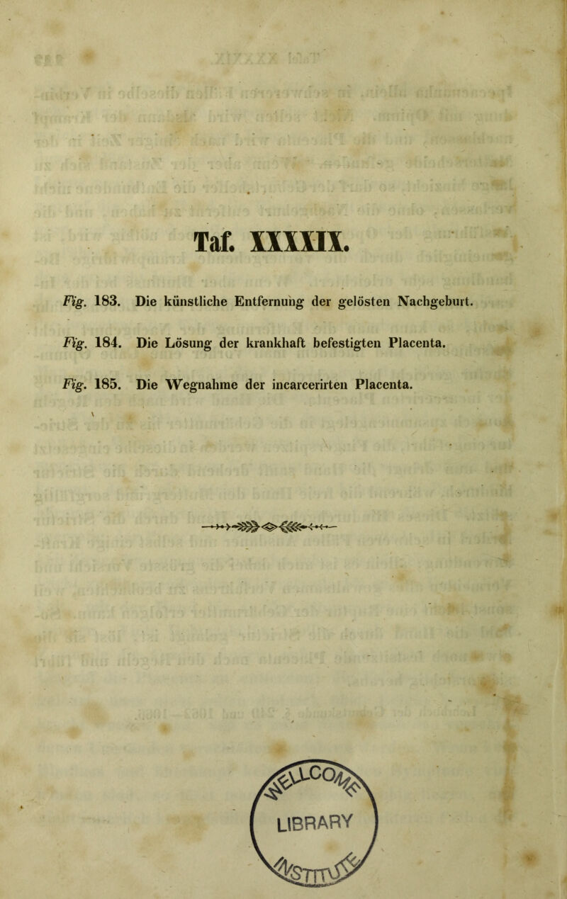 Fig. 183. Die künstliche Entfernung der gelösten Nachgeburt. Füg. 184. Die Lösung der krankhaft befestigten Placenta. Fig. 185. Die Wegnahme der incarcerirten Placenta. \