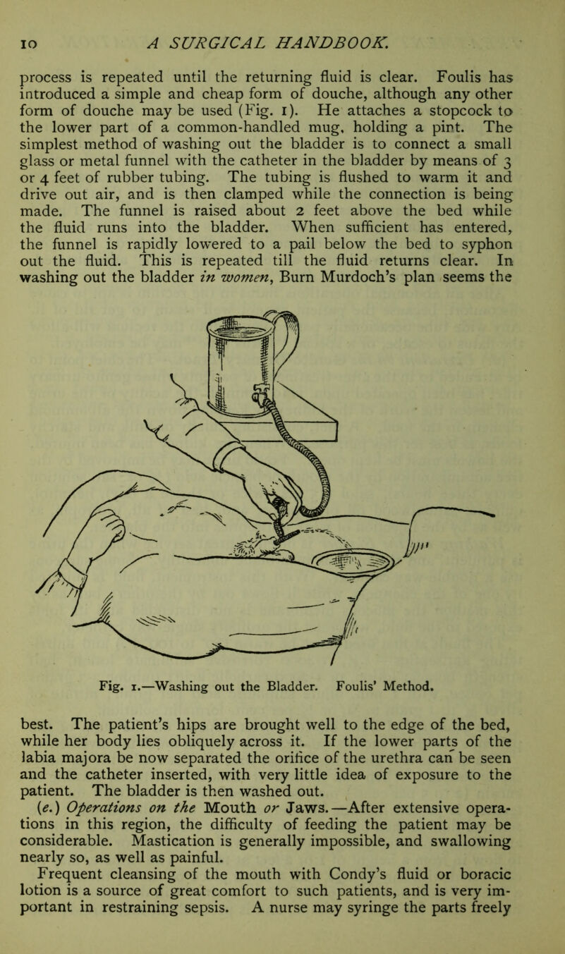process is repeated until the returning fluid is clear. Foulis has introduced a simple and cheap form of douche, although any other form of douche maybe used (Fig. i). He attaches a stopcock to the lower part of a common-handled mug, holding a pint. The simplest method of washing out the bladder is to connect a small glass or metal funnel with the catheter in the bladder by means of 3 or 4 feet of rubber tubing. The tubing is flushed to warm it and drive out air, and is then clamped while the connection is being made. The funnel is raised about 2 feet above the bed while the fluid runs into the bladder. When sufficient has entered, the funnel is rapidly lowered to a pail below the bed to syphon out the fluid. This is repeated till the fluid returns clear. In washing out the bladder in women, Burn Murdoch’s plan seems the best. The patient’s hips are brought well to the edge of the bed, while her body lies obliquely across it. If the lower parts of the labia majora be now separated the orifice of the urethra can be seen and the catheter inserted, with very little idea of exposure to the patient. The bladder is then washed out. (e.) Operations on the Mouth or Jaws.—After extensive opera- tions in this region, the difficulty of feeding the patient may be considerable. Mastication is generally impossible, and swallowing nearly so, as well as painful. Frequent cleansing of the mouth with Condy’s fluid or boracic lotion is a source of great comfort to such patients, and is very im- portant in restraining sepsis. A nurse may syringe the parts freely