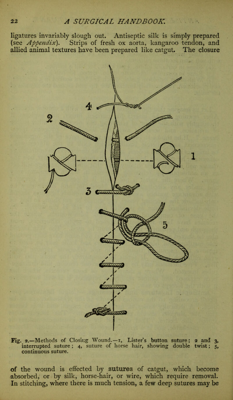 ligatures invariably slough out. Antiseptic silk is simply prepared (see Appendix). Strips of fresh ox aorta, kangaroo tendon, and allied animal textures have been prepared like catgut. The closure continuous suture. of the wound is effected by sutures of catgut, which become absorbed, or by silk, horse-hair, or wire, which require removal. In stitching, where there is much tension, a few deep sutures may be