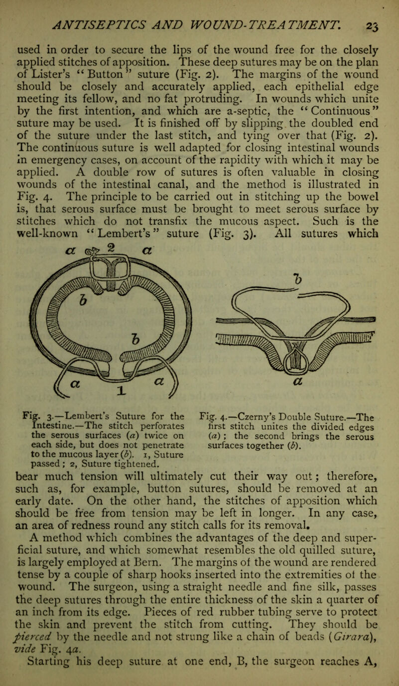 used in order to secure the lips of the wound free for the closely applied stitches of apposition. These deep sutures may be on the plan of Lister’s “ Button” suture (Fig. 2). The margins of the wound should be closely and accurately applied, each epithelial edge meeting its fellow, and no fat protruding. In wounds which unite by the first intention, and which are a-septic, the “ Continuous ” suture may be used. It is finished off by slipping the doubled end of the suture under the last stitch, and tying over that (Fig. 2). The continuous suture is well adapted for closing intestinal wounds in emergency cases, on account of the rapidity with which it may be applied. A double row of sutures is often valuable in closing wounds of the intestinal canal, and the method is illustrated in Fig. 4. The principle to be carried out in stitching up the bowel is, that serous surface must be brought to meet serous surface by stitches which do not transfix the mucous aspect. Such is the well-known “ Lembert’s ” suture (Fig. 3). All sutures which Fig. 3.—Lembert’s Suture for the Fig. 4.—Czerny’s Double Suture.—The Intestine.—The stitch perforates first stitch unites the divided edges the serous surfaces (a) twice on (a) ; the second brings the serous each side, but does not penetrate surfaces together (3). to the mucous layer (b). i, Suture passed ; 2, Suture tightened. bear much tension will ultimately cut their way out; therefore, such as, for example, button sutures, should be removed at an early date. On the other hand, the stitches of apposition which should be free from tension may be left in longer. In any case, an area of redness round any stitch calls for its removal. A method which combines the advantages of the deep and super- ficial suture, and which somewhat resembles the old quilled suture, is largely employed at Bern. The margins of the wound are rendered tense by a couple of sharp hooks inserted into the extremities of the wound. The surgeon, using a straight needle and fine silk, passes the deep sutures through the entire thickness of the skin a quarter of an inch from its edge. Pieces of red rubber tubing serve to protect the skin and prevent the stitch from cutting. They should be fierced by the needle and not strung like a chain of beads (Girara), vide Fig. 4a. Starting his deep suture at one end, B, the surgeon reaches A,