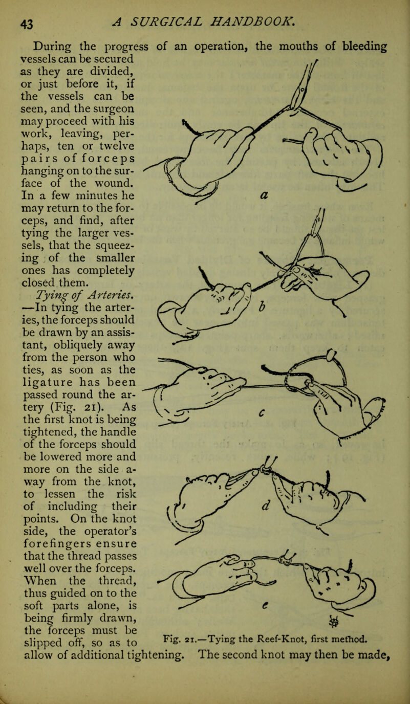 During the progress of an operation, the mouths of bleeding vessels can be secured as they are divided, or just before it, if the vessels can be seen, and the surgeon may proceed with his work, leaving, per- haps, ten or twelve pairs of forceps hanging on to the sur- face of the wound. In a few minutes he may return to the for- ceps, and find, after tying the larger ves- sels, that the squeez- ing of the smaller ones has completely closed them. Tying of Arteries. —In tying the arter- ies, the forceps should be drawn by an assis- tant, obliquely away from the person who ties, as soon as the ligature has been passed round the ar- tery (Fig. 21). As the first knot is being tightened, the handle of the forceps should be lowered more and more on the side a- way from the knot, to lessen the risk of including their points. On the knot side, the operator’s forefingers ensure that the thread passes well over the forceps. When the thread, thus guided on to the soft parts alone, is being firmly drawn, the forceps must be slipped off, so as to F!S- «--Tying the Reef-Knot, first method. allow of additional tightening. The second knot may then be made.