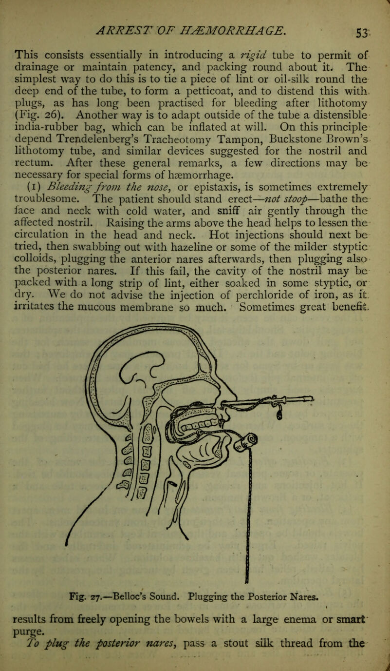 This consists essentially in introducing a rigid tube to permit of drainage or maintain patency, and packing round about it* The simplest way to do this is to tie a piece of lint or oil-silk round the deep end of the tube, to form a petticoat, and to distend this with plugs, as has long been practised for bleeding after lithotomy (Fig. 26). Another way is to adapt outside of the tube a distensible india-rubber bag, which can be inflated at will. On this principle depend Trendelenberg’s Tracheotomy Tampon, Buckstone Brown’s lithotomy tube, and similar devices suggested for the nostril and rectum. After these general remarks, a few directions may be necessary for special forms of hoemorrhage. (1) Bleeding from the nose, or epistaxis, is sometimes extremely troublesome. The patient should stand erect—not stoop—bathe the face and neck with cold water, and sniff air gently through the affected nostril. Raising the arms above the head helps to lessen the circulation in the head and neck. Hot injections should next be tried, then swabbing out with hazeline or some of the milder styptic colloids, plugging the anterior nares afterwards, then plugging also the posterior nares. If this fail, the cavity of the nostril may be packed with a long strip of lint, either soaked in some styptic, or dry. We do not advise the injection of perchloride of iron, as it. irritates the mucous membrane so much. Sometimes great benefit. Fig. 27.—Belloc’s Sound. Plugging the Posterior Nares. results from freely opening the bowels with a large enema or smart purge. To plug the posterior nares, pass a stout silk thread from the