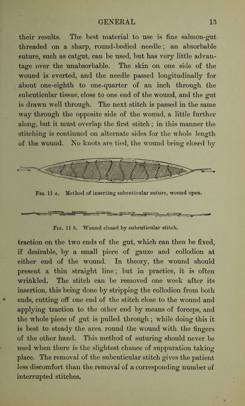 their results. The best material to use is fine salmon-gut threaded on a sharp, round-bodied needle; an absorbable suture, such as catgut, can be used, but has very little advan- tage over the unabsorbable. The skin on one side of the wound is everted, and the needle passed longitudinally for about one-eighth to one-quarter of an inch through the subcuticular tissue, close to one end of the wound, and the gut is drawn well through. The next stitch is passed in the same way through the opposite side of the wound, a little further along, but it must overlap the first stitch; in this manner the stitching is continued on alternate sides for the whole length of the wound. No knots are tied, the wound being closed by Fig. 11 a. Method of inserting subcuticular suture, wound open. Fig. 11 b. Wound closed by subcuticular stitch. traction on the two ends of the gut, which can then be fixed, if desirable, by a small piece of gauze and collodion at either end of the wound. In theory, the wound should present a thin straight line; but in practice, it is often wrinkled. The stitch can be removed one week after its insertion, this being done by stripping the collodion from both ends, cutting off* one end of the stitch close to the wound and applying traction to the other end by means of forceps, and the whole piece of gut is pulled through; while doing this it is best to steady the area round the wound with the fingers of the other hand. This method of suturing should never be used when there is the slightest chance of suppuration taking place. The removal of the subcuticular stitch gives the patient less discomfort than the removal of a corresponding number of interrupted stitches.