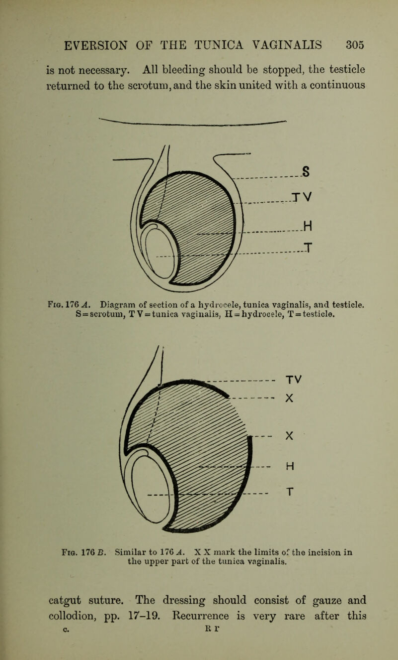 is not necessary. All bleeding should be stopped, the testicle returned to the scrotum, and the skin united with a continuous Fig. 176 A. Diagram of section of a hydrocele, tunica vaginalis, and testicle. Sss scrotum, TV = tunica vaginalis, H = hydrocele, T = testicle. TV X X H T Fig. 176 B. Similar to 176 A. XX mark the limits of the incision in the upper part of the tunica vaginalis. catgut suture. The dressing should consist of gauze and collodion, pp. 17-19. Recurrence is very rare after this