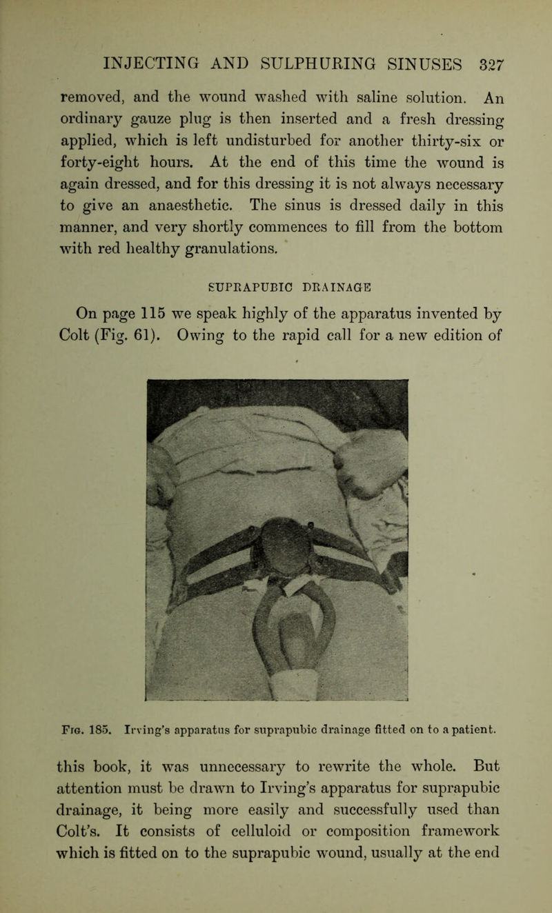 removed, and the wound washed with saline solution. An ordinary gauze plug is then inserted and a fresh dressing applied, which is left undisturbed for another thirty-six or forty-eight hours. At the end of this time the wound is again dressed, and for this dressing it is not always necessary to give an anaesthetic. The sinus is dressed daily in this manner, and very shortly commences to fill from the bottom with red healthy granulations. SUPRAPUBIC DRAINAGE On page 115 we speak highly of the apparatus invented by Colt (Fig. 61). Owing to the rapid call for a new edition of FrG. 185. Irving’s apparatus for suprapubic drainage fitted on to a patient. this book, it was unnecessary to rewrite the whole. But attention must be drawn to Irving’s apparatus for suprapubic drainage, it being more easily and successfully used than Colt’s. It consists of celluloid or composition framework which is fitted on to the suprapubic wound, usually at the end