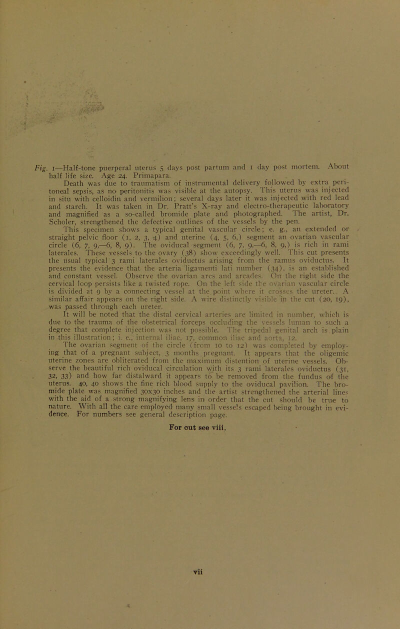 a. Fig. i—Half-tone puerperal uterus 5 clays post partum and 1 day post mortem. About half life size. Age 24. Primapara. Death was due to traumatism of instrumental delivery followed by extra peri- toneal sepsis, as no peritonitis was visible at the autopsy. 1 his uterus was injected in situ with celloidin and vermilion; several days later it was injected with red lead and starch. It was taken in Dr. Pratt’s X-ray and electro-therapeutic laboratory and magnified as a so-called bromide plate and photographed. The artist, Dr. Scholer, strengthened the defective outlines of the vessels by the pen. This specimen shows a typical genital vascular circle; e. g., an extended or straight pelvic floor (1, 2, 3, 4) and uterine (4. 5, 6,) segment an ovarian vascular circle (6, 7, 9,—6, 8, 9). The oviducal segment (6, 7. 9,—6, 8, 9,) is rich in rami laterales. These vessels to the ovary (38) show exceedingly well. This cut presents the usual typical 3 rami laterales oviductus arising from the ramus oviductus. It presents the evidence that the arteria ligamenti lati number (34), is an established and constant vessel. Observe the ovarian arcs and arcades. On the right side the cervical loop persists like a twisted rope. On the left side the ovarian vascular circle is divided at 9 by a connecting vessel at the. point where it crosses the ureter. A similar affair appears on the right side. A wire distinctly visible in the cut (20, 19), was passed through each ureter. It will be noted that the distal cervical arteries are limited in number, which is due to the trauma of the obstetrical forceps occluding the vessels luman to such a degree that complete injection was not possible. The tripedal genital arch is plain in this illustration; i. e., internal iliac. 17, common iliac and aorta, 12. The ovarian segment of the circle (from 10 to 12) was completed by employ- ing that of a pregnant subject, 3 months pregnant. It appears that the oligemic uterine zones are obliterated from the maximum distention of uterine vessels. Ob- serve the beautiful rich oviducal circulation with its 3 rami laterales oviductus (31, 32, 33) and how far distalward it appears to be removed from the fundus of the uterus. 40, 40 shows the fine rich blood supply to the oviducal pavilion. The bro- mide plate was magnified 30x30 inches and the artist strengthened the arterial lines with the aid of a strong magnifying lens in order that the cut should be true to nature. With all the care employed many small vessels escaped being brought in evi- dence. For numbers see general description page. For out see viii.