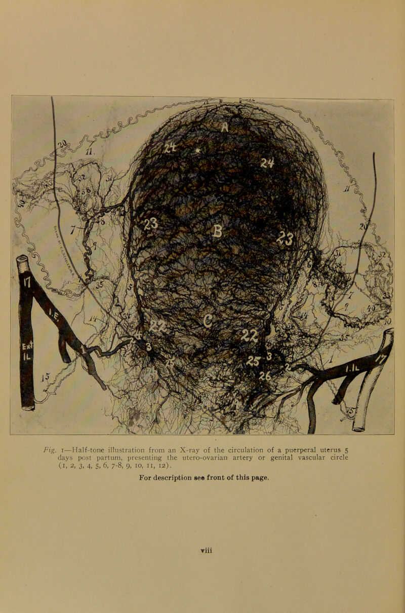 Fig. i—Half-tone illustration from an X-ray of the circulation of a puerperal uterus 5 days post part uni, presenting the utero-ovarian artery or genital vascular circle (1, 2, 3. 4, 5, 6, 7-8, 9, 10, ii, 12). For description see front of this page.