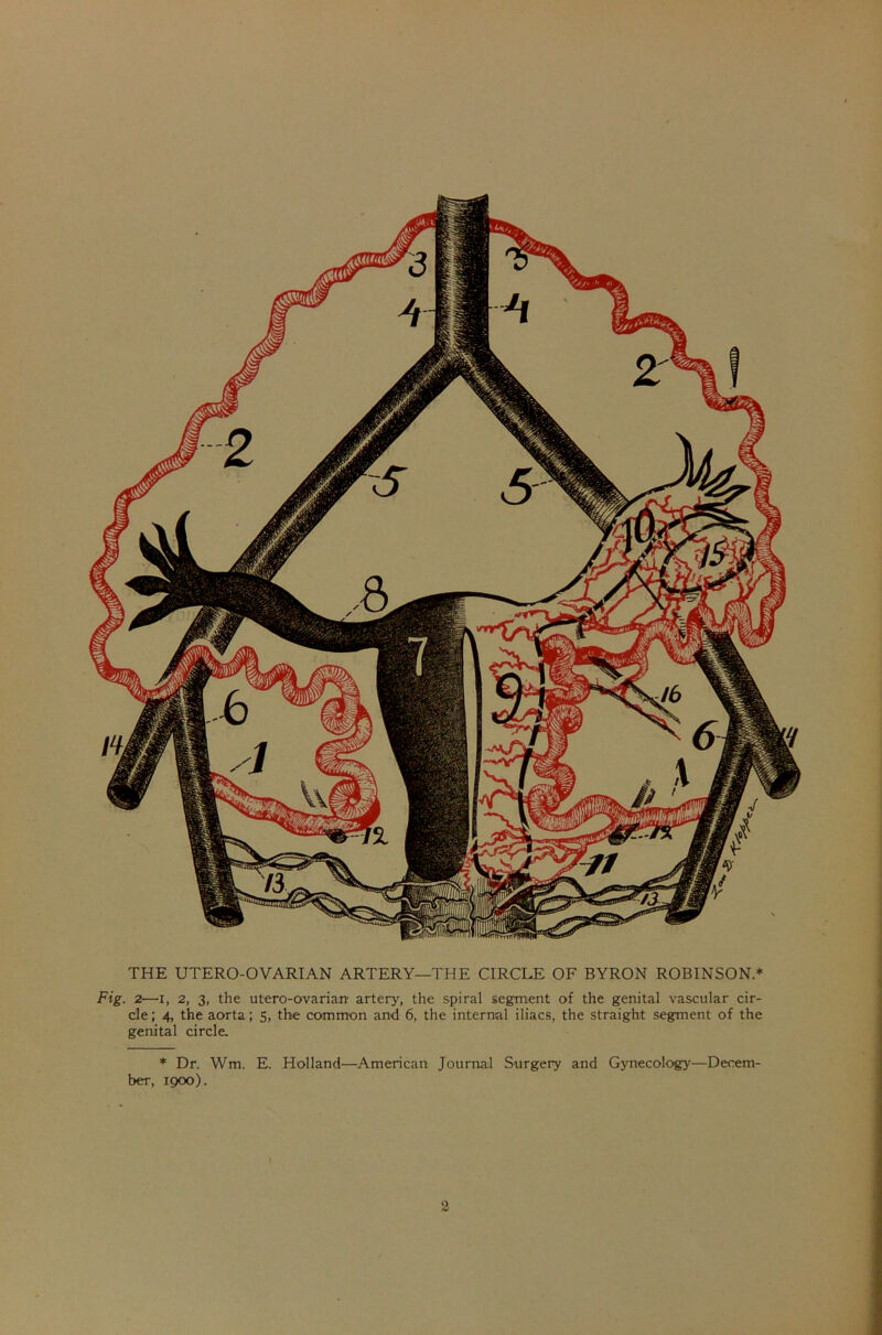 THE UTERO-OVARIAN ARTERY—THE CIRCLE OF BYRON ROBINSON * Fig. 2—i, 2, 3, the utero-ovarian artery, the spiral segment of the genital vascular cir- cle ; 4, the aorta; 5, the common and 6, the internal iliacs, the straight segment of the genital circle. * Dr. Wm. E. Holland—American Journal Surgery and Gynecology'—Decem- ber, 1900).