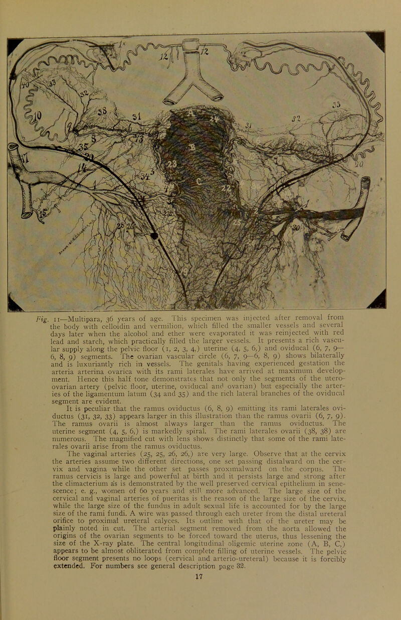 Fig. ii—Multipara, 36 years of age. This specimen was injected after removal from the body with celloidin and vermilion, which filled the smaller vessels and several days later when the alcohol and ether were evaporated it was reinjected with red lead and starch, which practically filled the larger vessels. It presents a rich vascu- lar supply along the pelvic floor (1, 2, 3, 4,) uterine (4, 5, 6,) and oviducal (6, 7, 9— 6, 8, 9) segments. The ovarian vascular circle (6, 7, 9—6, 8, 9) shows bilaterally and is luxuriantly rich in vessels. The genitals having experienced gestation the arteria arterina ovarica with its rami laterales have arrived at maximum develop- ment. Hence this half tone demonstrates that not only the segments of the utero- ovarian artery (pelvic floor, uterine, oviducal and ovarian) but especially the arter- ies of the ligamentum latum (34 and 35) and the rich lateral branches of the oviducal segment are evident. It is peculiar that the ramus oviductus (6, 8, 9) emitting its rami laterales ovi- ductus (31, 32, 33) appears larger in this illustration than the ramus ovarii (6, 7, 9). The ramus ovarii is almost always larger than the ramus oviductus. The uterine segment (4, 5, 6,) is markedly spiral. The rami laterales ovarii (38, 38) are numerous. The magnified cut with lens shows distinctly that some of the rami late- rales ovarii arise from the ramus oviductus. The vaginal arteries (25, 25, 26, 26,) are very large. Observe that at the cervix the arteries assume two different directions, one set passing distalward on the cer- vix and vagina while the other set passes proxnnalward on the corpus. The ramus cervicis is large and powerful at birth and it persists large and strong after the climacterium as is demonstrated by the well preserved cervical epithelium in sene- scence; e. g., women of 60 years and still more advanced. The large size of the cervical and vaginal arteries of pueritas is the reason of the large size of the cervix, while the large size of the fundus in adult sexual life is accounted for by the large size of the rami fundi. A wire was passed through each ureter from the distal ureteral orifice to proximal ureteral calyces. Its outline with that of the ureter may be plainly noted in cut. The arterial segment removed from the aorta allowed the origins of the ovarian segments to be forced toward the uterus, thus lessening the size of the X-ray plate. The central longitudinal oligemic uterine zone (A, B, C,) appears to be almost obliterated from complete filling of uterine vessels. The pelvic floor segment presents no loops (cervical and arterio-ureteral) because it is forcibly extended. For numbers see general description page 32.