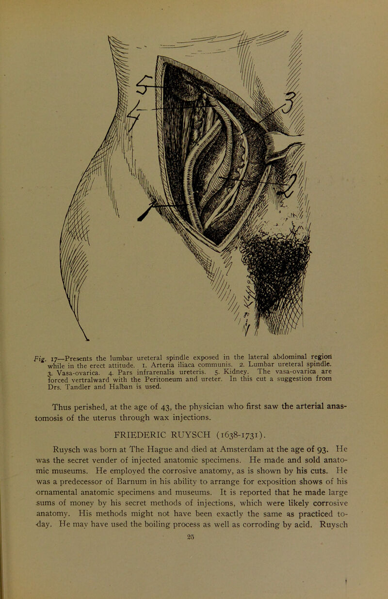 pig. iy—Presents the lumbar ureteral spindle exposed in the lateral abdominal region while in the erect attitude, x. Arteria iliaca communis. 2. Lumbar ureteral spindle. 3. Vasa-ovarica. 4. Pars infrarenalis ureteris. 5. Kidney. The vasa-ovarica are forced vertralward with the Peritoneum and ureter. In this cut a suggestion from Drs. Tandler and Halban is used. Thus perished, at the age of 43, the physician who first saw the arterial anas- tomosis of the uterus through wax injections. FRIEDERIC RUYSCH (1638-1731). Ruysch was born at The Hague and died at Amsterdam at the age of 93. He was the secret vender of injected anatomic specimens. He made and sold anato- mic museums. Fie employed the corrosive anatomy, as is shown by his cuts. He was a predecessor of Barnum in his ability to arrange for exposition shows of his ornamental anatomic specimens and museums. It is reported that he made large sums of money by his secret methods of injections, which were likely corrosive anatomy. His methods might not have been exactly the same as practiced to- -day. He may have used the boiling process as well as corroding by acid. Ruysch I