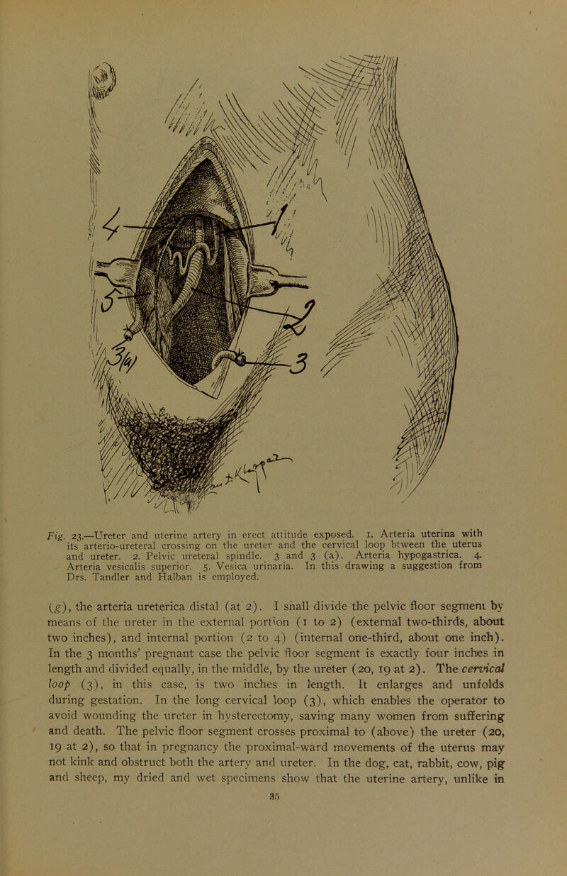 Fig. 23.—Ureter and uterine artery in erect attitude exposed. 1. Arteria uterina with its arterio-ureteral crossing on the ureter and the cervical loop btween the uterus and ureter. 2. Pelvic ureteral spindle. 3 and 3 (a). Arteria hypogastrica. 4. Arteria vesicalis superior. 5. Vesica urinaria. In this drawing a suggestion from Drs. Tandler and Halban is employed. (g), the arteria ureterica distal (at 2). I shall divide the pelvic floor segment by means of the ureter in the external portion (1 to 2) (external two-thirds, about two inches), and internal portion (2 to 4) (internal one-third, about one inch). In the 3 months’ pregnant case the pelvic floor segment is exactly four inches in length and divided equally, in the middle, by the ureter (20, 19 at 2). The cervical loop (3), in this case, is two inches in length. It enlarges and unfolds during gestation. In the long cervical loop (3), which enables the operator to avoid wounding the ureter in hysterectomy, saving many women from suffering and death. The pelvic floor segment crosses proximal to (above) the ureter (20, 19 at 2), so that in pregnancy the proximal-ward movements of the uterus may not kink and obstruct both the artery and ureter. In the dog, cat, rabbit, cow, pig and sheep, my dried and wet specimens show that the uterine artery, unlike in