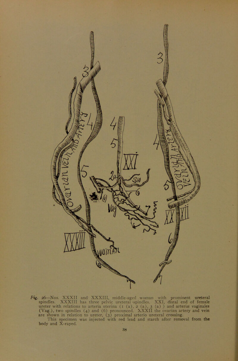 Fig. 26—Nos. XXXII and XXXIII, middle-aged woman with prominent ureteral spindles. XXXIII has three pelvic ureteral -spindles. XXI, distal end of female ureter with relations to arteria uterina (1 (a), 2 (a), 3 (a) ) and arterial vaginales (Vag.), two spindles (4) and (6) pronounced. XXXII the ovarian artery and vein are shown in relation to ureter, (3) proximal arterio ureteral crossing. This specimen was injected with red lead and starch after removal from the body and X-rayed.