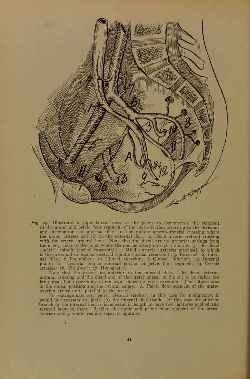 of the ureter and pelvic floor segment of the utero-ovarian artery; also the divisions and distributions of internal iliac.—1. The middle arterio-ureteral crossing where the ureter crosses entirely on the external iliac. 2. Distal arterio-ureteral crossing with the arterio-ureteral loop. Note that the distal arteria ureterica springs from the artery close to the point where the uterine artery crosses the ureter. 3. The distal (pelvic) spindle (urinal reservoir) ; 4. Middle arteria ureterica proximal, to which is the proximal or lumbar ureteral spindle (urinal reservoir) ; 5. External; 6. Inter- nal iliac; 7. Ueolumbar; 10. Gluteal superior; 8. Gluteal inferior; 11. Internal pudic; 12. Cervical loop or internal portion of pelvic floor segment; 13. Vesicle arteries; 16. Obturator; 17. Hypogastric. Note that the ureter lies anterior to the internal iliac. The distal arterio- ureteral crossing and the distal end of the ureter appear in the cut to be rather too far dorsal, but dissections, as my own, showed a wide variation. The subject was in the dorsal position and the rectum empty. A. Pelvic floor segment of the utero- ovarian artery quite parallel to the ureter. To exsanguinate any pelvic visceral territory in this case for malignancy, it would be necessary to ligate (6) the internal iliac trunk. In this case the anterior branch of the internal iliac is insufficient in length to have two ligatures applied and severed between them. Besides, the pudic and pelvic floor segment of the utero- ovarian artery would require separate ligatures.