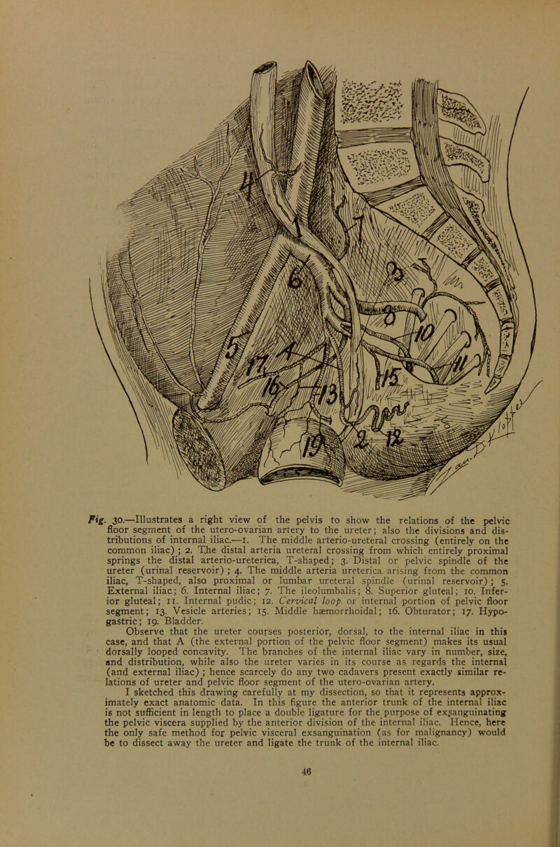 Fig. 30-—Illustrates a right view of the pelvis to show the relations of the pelvic floor segment of the utero-ovarian artery to the ureter; also the divisions and dis- tributions of internal iliac.—I. The middle arterio-ureteral crossing (entirely on the common iliac) ; 2. The distal arteria ureteral crossing from which entirely proximal springs the distal arterio-ureterica, T-shaped; 3. Distal or pelvic spindle of the ureter (urinal reservoir) ; 4. The middle arteria ureterica. arising from the common iliac, T-shaped, also proximal or lumbar ureteral spindle (urinal reservoir); 5. External iliac; 6. Internal iliac; 7. The ileolumbalis; 8. Superior gluteal; 10. Infer- ior gluteal; xx. Internal pudic; 12. Cervical loop or internal portion of pelvic floor segment; 13. Vesicle arteries; 15. Middle hsemorrhoidal; 16. Obturator; 17. Hypo- gastric; 19. Bladder. Observe that the ureter courses posterior, dorsal, to the internal iliac in this case, and that A (the external portion of the pelvic floor segment) makes its usual dorsally looped concavity. The branches of the internal iliac vary in number, size, and distribution, while also the ureter varies in its course as regards the internal (and external iliac) ; hence scarcely do any two cadavers present exactly similar re- lations of ureter and pelvic floor segment of the utero-ovarian artery. I sketched this drawing carefully at my dissection, so that it represents approx- imately exact anatomic data. In this figure the anterior trunk of the internal iliac is not sufficient in length to place a double ligature for the purpose of exsanguinating the pelvic viscera supplied by the anterior division of the internal iliac. Hence, here the only safe method for pelvic visceral exsanguination (as for malignancy) would be to dissect away the ureter and ligate the trunk of the internal iliac.