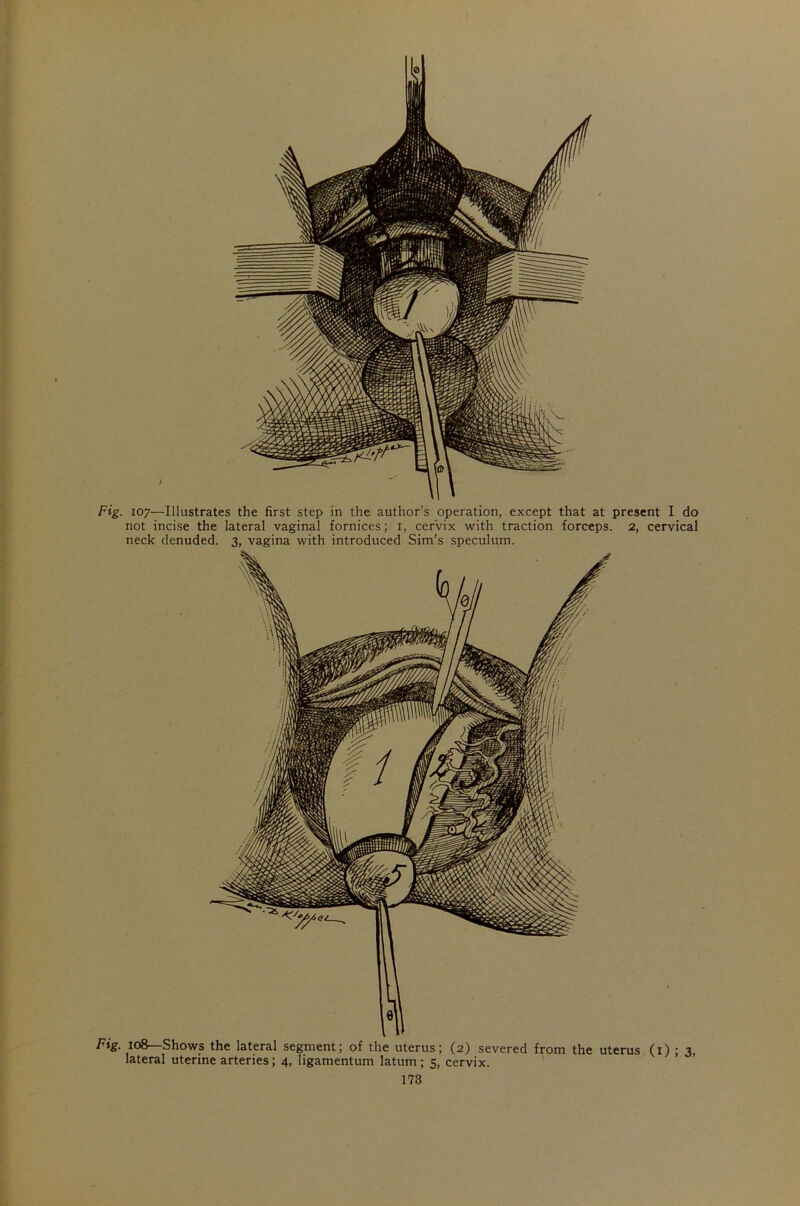 / Fig. 107—Illustrates the first step in the author’s operation, except that at present I do not incise the lateral vaginal fornices; 1, cervix with traction forceps. 2, cervical neck denuded. 3, vagina with introduced Sim’s speculum. Fig. 108—Shows the lateral segment; of the uterus; (2) severed from the uterus (1) ; 3, lateral uterine arteries; 4, ligamentum latum; 5, cervix.