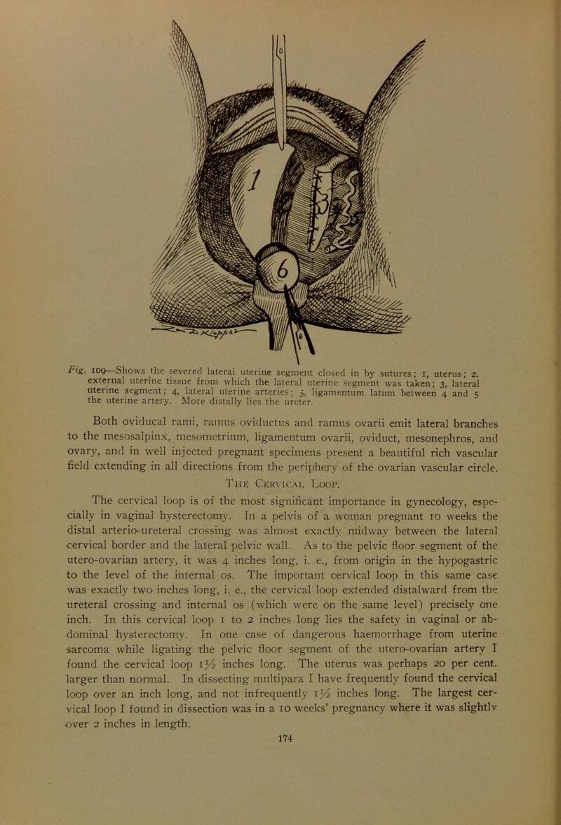 Fir. log Shows the severed lateral uterine segment closed in by sutures; i, uterus; 2, external uterine tissue from which the lateral uterine segment was taken; 3, lateral uterine segment; 4, lateral uterine arteries; 5, ligamentum latum between 4 and 5 the uterine artery. More distally lies the ureter. Both oviducal rami, ramus oviductus and ramus ovarii emit lateral branches to the mesosalpinx, mesometrium, ligamentum ovarii, oviduct, mesonephros, and ovary, and in well injected pregnant specimens present a beautiful rich vascular field extending in all directions from the periphery of the ovarian vascular circle. The Cervical Loop. The cervical loop is of the most significant importance in gynecology, espe- cially in vaginal hysterectomy. In a pelvis of a woman pregnant 10 weeks the distal arterio-ureteral crossing was almost exactly midway between the lateral cervical border and the lateral pelvic wall. As to the pelvic floor segment of the utero-ovarian artery, it was 4 inches long, i. e., from origin in the hypogastric to the level of the internal os. The important cervical loop in this same case was exactly two inches long, i. e., the cervical loop extended distalward from the ureteral crossing and internal os (which were on the same level) precisely one inch. In this cervical loop 1 to 2 inches long lies the safety in vaginal or ab- dominal hysterectomy. In one case of dangerous haemorrhage from uterine sarcoma while ligating the pelvic floor segment of the ntero-ovarian artery I found the cervical loop 154 inches long. The uterus was perhaps 20 per cent, larger than normal. In dissecting multipara I have frequently found the cervical loop over an inch long, and not infrequently i)4 inches long. The largest cer- vical loop I found in dissection was in a 10 weeks’ pregnancy where it was slightlv over 2 inches in length.