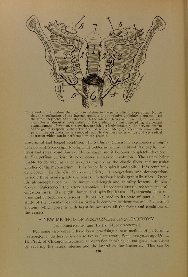 Fig. hi—Is a cut to show the organs in relation to the pelvis after the operation. Notice that the mechanism of the internal genitals is but relatively slightly disturbed, ist the lateral segments of the uterus with the lateral arteries are intact. 2, the vascular apparatus is almost entirely intact; 3, the oviducts are not changed; 4, the central sexual onjans of woman, the ovaries, are left perfectly intact; 5, the nervous system of the genitals especially the pelvic brain is not wounded; 6, the endometrium with a part of the myometrium is removed; 7, it is the most conservative and yet radical operation which can be performed on the genitals. ume, spiral and looped condition. In Gestation (Crisis) it experiences a mighty development from origin to origin. It trebles in volume of blood. Its length, lumen, loops and spiral condition rapidly increased and it becomes completely developed. In Pncrperium (Crisis) it experiences a marked involution. The artery being unable to contract after delivery as rapidly as the elastic fibers and muscular bundles of the myometrium. It is forced into spirals and coils. It is completely developed. In the Climacterium (Crisis) its congestions and decongestions, periodic hyperaemia gradually ceases. Arterio-sclerosis gradually rises. Oster- itis physiologica occurs. Its lumen and length and spirality lessens. In Sen- esence (Quiescence) the artery atrophies. It bocomes arterio sclerotic and cal- cification rises. Its length, lumen and spirality lessen. Hyperaemia does not arise and it becomes quiescent. It has returned to its state of pueritas. No study of the vascular part of an organ is complete without the aid of corrosion anatomy which presents with beautiful accuracy all the forms and conditions of the vessels. A NEW METHOD OF PERFORMING HYSTERECTOMY. (Endometrectomy and Partial Myometrectomv.) For some two years I have been practising a new method of performing hysterectomy. At least it is new so far as I am aware. Some five years ago Dr. E. H. Pratt, of Chicago, introduced an operation in which he extirpated the uterus by severing the lateral uterine and the lateral oviducal arteries. This can be