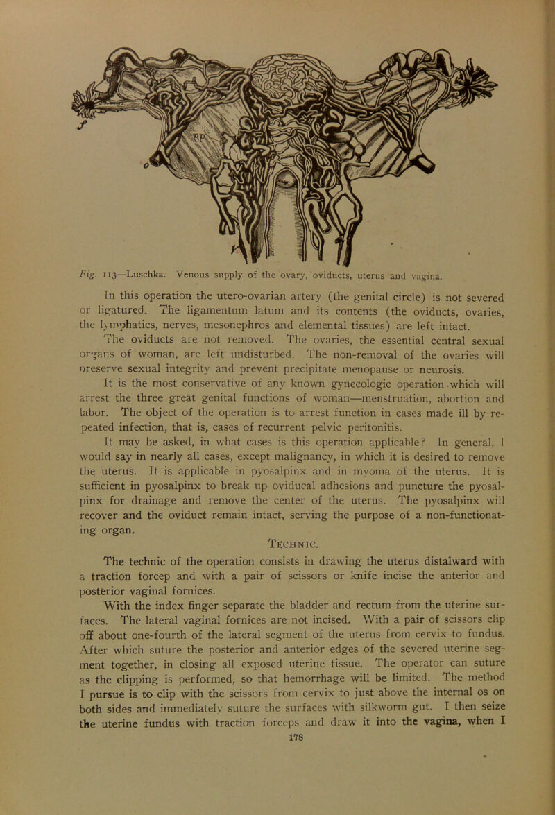 Fig. 113—Luschka. Venous supply of the ovary, oviducts, uterus and vagina. In this operation the utero-ovarian artery (the genital circle) is not severed or ligatured. The ligamentum latum and its contents (the oviducts, ovaries, the lymphatics, nerves, mesonephros and elemental tissues) are left intact. The oviducts are not removed. The ovaries, the essential central sexual organs of woman, are left undisturbed. The non-removal of the ovaries will oreserve sexual integrity and prevent precipitate menopause or neurosis. It is the most conservative of any known gynecologic operation .which will arrest the three great genital functions of woman—menstruation, abortion and labor. The object of the operation is to arrest function in cases made ill by re- peated infection, that is, cases of recurrent pelvic peritonitis. It may be asked, in what cases is this operation applicable? In general, 1 would say in nearly all cases, except malignancy, in which it is desired to remove the uterus. It is applicable in pyosalpinx and in myoma of the uterus. It is sufficient in pyosalpinx to break up oviducal adhesions and puncture the pyosal- pinx for drainage and remove the center of the uterus. The pyosalpinx will recover and the oviduct remain intact, serving the purpose of a non-functionat- ing organ. Technic. The technic of the operation consists in drawing the uterus distalward with a traction forcep and with a pair of scissors or knife incise the anterior and posterior vaginal fomices. With the index finger separate the bladder and rectum from the uterine sur- faces. The lateral vaginal fornices are not incised. With a pair of scissors clip off about one-fourth of the lateral segment of the uterus from cervix to fundus. After which suture the posterior and anterior edges of the severed uterine seg- ment together, in closing all exposed uterine tissue. The operator can suture as the clipping is performed, so that hemorrhage will be limited. The method I pursue is to clip with the scissors from cervix to just above the internal os on both sides and immediately suture the surfaces with silkworm gut. I then seize the uterine fundus with traction forceps and draw it into the vagina, when I