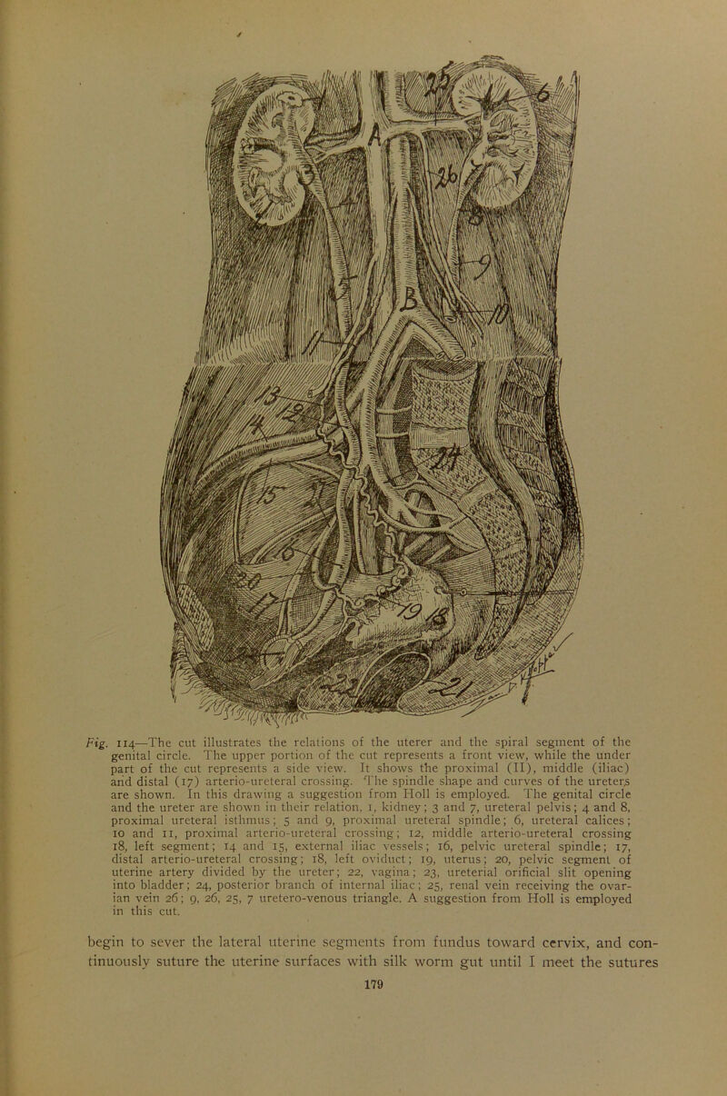 Fig. 114—The cut illustrates the relations of the uterer and the spiral segment of the genital circle. The upper portion of the cut represents a front view, while the under part of the cut represents a side view. It shows the proximal (II), middle (iliac) and distal (17) arterio-ureteral crossing. The spindle shape and curves of the ureters are shown. In this drawing a suggestion from Holl is employed. The genital circle and the ureter are shown in their relation, 1, kidney; 3 and 7, ureteral pelvis; 4 and 8, proximal ureteral isthmus; 5 and 9, proximal ureteral spindle; 6, ureteral calices; 10 and 11, proximal arterio-ureteral crossing; 12, middle arterio-ureteral crossing 18, left segment; 14 and 15, external iliac vessels; 16, pelvic ureteral spindle; 17, distal arterio-ureteral crossing; 18, left oviduct; 19, uterus; 20, pelvic segment of uterine artery divided by the ureter; 22, vagina; 23, ureterial orificial slit opening into bladder; 24, posterior branch of internal iliac; 25, renal vein receiving the ovar- ian vein 26; 9, 26, 25, 7 uretero-venous triangle. A suggestion from Holl is employed in this cut. begin to sever the lateral uterine segments from fundus toward cervix, and con- tinuously suture the uterine surfaces with silk worm gut until I meet the sutures