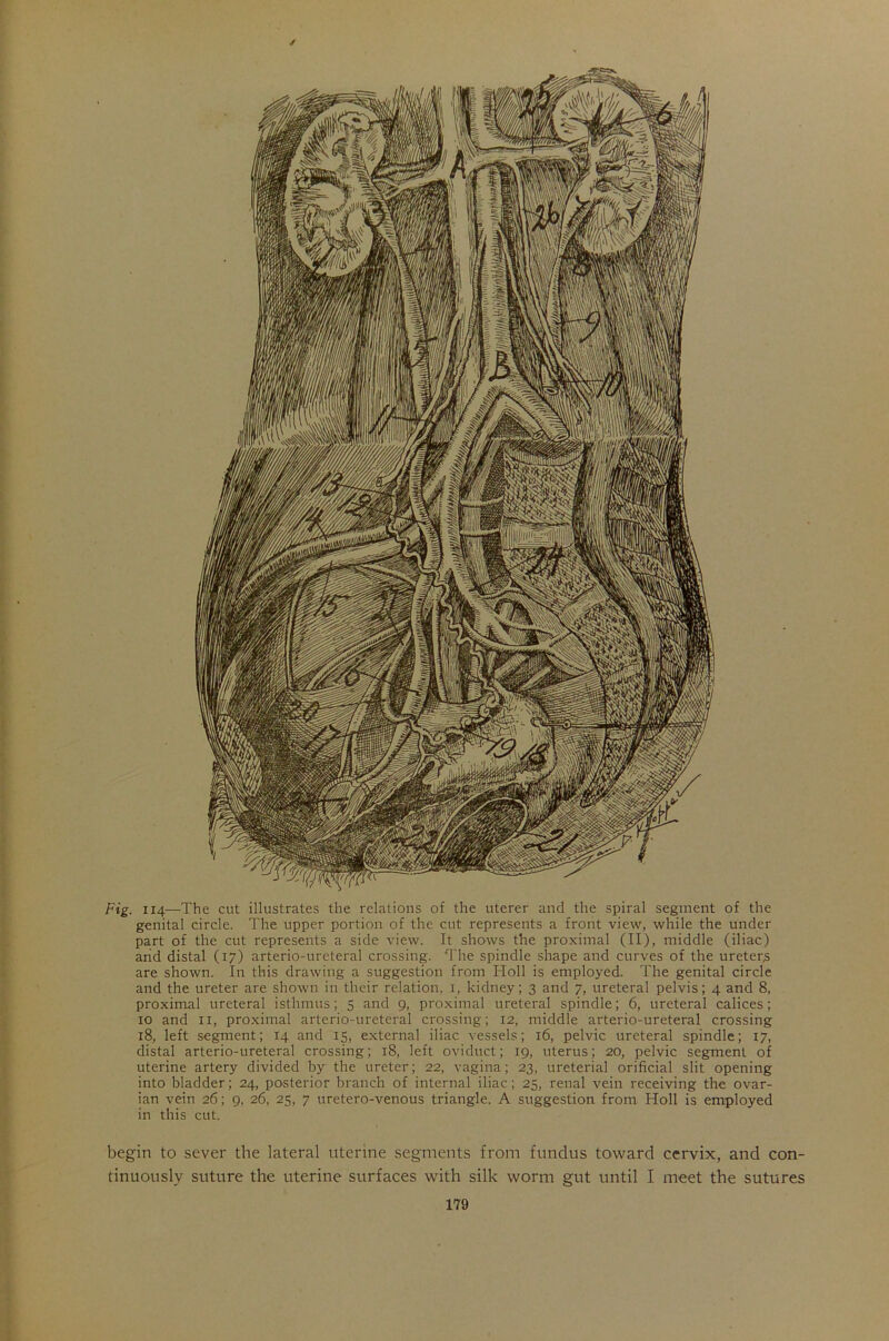 Fig. 114—The cut illustrates the relations of the uterer and the spiral segment of the genital circle. The upper portion of the cut represents a front view, while the under part of the cut represents a side view. It shows the proximal (II), middle (iliac) and distal (17) arterio-ureteral crossing. The spindle shape and curves of the ureters are shown. In this drawing a suggestion from Holl is employed. The genital circle and the ureter are shown in their relation, 1, kidney; 3 and 7, ureteral pelvis; 4 and 8, proximal ureteral isthmus; 5 and 9, proximal ureteral spindle; 6, ureteral calices; 10 and 11, proximal arterio-ureteral crossing; 12, middle arterio-ureteral crossing 18, left segment; 14 and 15, external iliac vessels; 16, pelvic ureteral spindle; 17, distal arterio-ureteral crossing; 18, left oviduct; 19, uterus; 20, pelvic segment of uterine artery divided by the ureter; 22, vagina; 23, ureterial orificial slit opening into bladder; 24, posterior branch of internal iliac; 25, renal vein receiving the ovar- ian vein 26; 9, 26, 25, 7 uretero-venous triangle. A suggestion from Holl is employed in this cut. begin to sever the lateral uterine segments from fundus toward cervix, and con- tinuously suture the uterine surfaces with silk worm gut until I meet the sutures