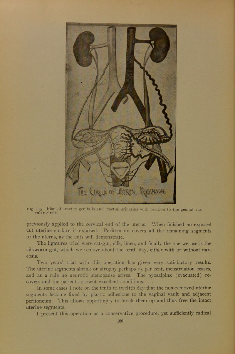 Fig. US—Plan of tract us genitalis and tractus urinarius with relation to the genital vas- cular circle. previously applied to the cervical end of the uterus. When finished no exposed cut uterine surface is exposed. Peritoneum covers all the remaining segments of the uterus, as the cuts will demonstrate. The ligatures tried were cat-gut, silk, linen, and finally the one we use is the silkworm gut, which we remove about the tenth day, either with or without nar- cosis. Two years’ trial with this operation has given very satisfactory results. The uterine segments shrink or atrophy perhaps 25 per cent, menstruation ceases, and as a rule no neurotic menopause arises. The pyosalpinx (evacuated) re- covers and the patients present excellent conditions. In some cases I note on the tenth to twelfth day that the non-removed uterine segments become fixed by plastic adhesions to the vaginal vault and adjacent peritoneum. This allows opportunity to break them up and thus free the intact uterine segments. I present this operation as a conservative procedure, yet sufficiently radical