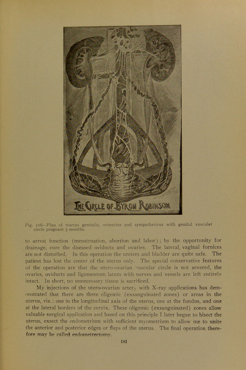 Fig. 116—Plan of tractus genitalis, urinarius and sympatheticus with genital vascular circle pregnant 3 months. to arrest function (menstruation, abortion and labor) ; by the opportunity for drainage, cure the diseased oviducts and ovaries. The lateral, vaginal fornices are not disturbed. In this operation the ureters and bladder are quite safe. The patient has lost the center of the uterus only. The special conservative features of the operation are that the utero-ovarian vascular circle is not severed, the ovaries, oviducts and ligamentum latum with nerves and vessels are left entirely intact. In short, no unnecessary tissue is sacrificed. My injections of the utero-ovarian artery with X-ray applications has dem- onstrated that there are three oligemic (exsanguinated zones) or areas in the uterus, viz.: one in the longitudinal axis of the uterus, one at the fundus, and one at the lateral borders of the cervix. These oligemic (exsanguinated) zones allow valuable surgical application and based on this principle I later began to bisect the uterus, exsect the endometrium with sufficient myometrium to allow me to unite the anterior and posterior edges or flaps of the uterus. The final operation there- fore may be called endometrectomy.