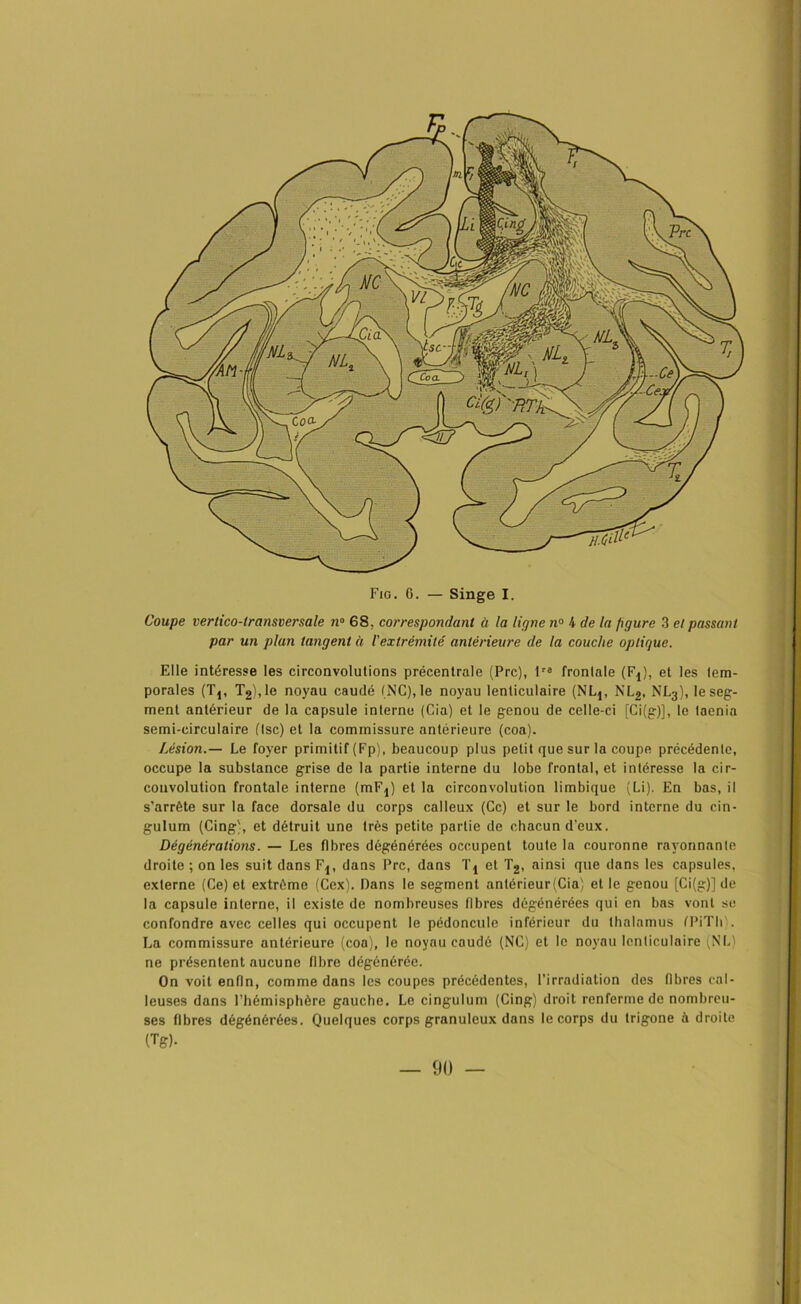 ■ • • ’l ' • ‘ ' f \ ‘ * 1 * '/ , 11 \ . \ ■ • • • / t , \ \. , } ( I \ \ CJcbÆmh-,:MA w Fig. G. — Singe I. Coupe vertico-lrcinsversale n° 68, correspondant à la ligne n° 4 de la figure 3 elpassant par un plan tangent à l'extrémité antérieure de la couche optique. Elle intéresse les circonvolutions précentrale (Prc), lre frontale (F!), et les tem- porales (Tj, T2),le noyau caudé (NC), le noyau lenticulaire (NLj, NL2, NL3), le seg- ment antérieur de la capsule interne (Cia) et le genou de celle-ci [Ci(g)], le taenia semi-circulaire (tse) et la commissure antérieure (coa). Lésion.— Le foyer primitif (Fp), beaucoup plus petit que sur la coupe précédente, occupe la substance grise de la partie interne du lobe frontal, et intéresse la cir- convolution frontale interne (mFj) et la circonvolution limbique (Li). En bas, il s’arrête sur la face dorsale du corps calleux (Ce) et sur le bord interne du cin- gulum (Cing), et détruit une très petite partie de chacun d’eux. Dègènèralions. — Les fibres dégénérées occupent toute la couronne rayonnante droite ; on les suit dans Fj, dans Prc, dans Tj et T2, ainsi que dans les capsules, externe (Ce) et extrême (Cex). Dans le segment antérieur (Cia) et le genou [Ci(g)J de la capsule interne, il existe de nombreuses fibres dégénérées qui en bas vont se confondre avec celles qui occupent le pédoncule inférieur du thalamus (PiTli). La commissure antérieure (coa), le noyau caudé (NC) et le noyau lenticulaire (NL) ne présentent aucune fibre dégénérée. On voit enfin, comme dans les coupes précédentes, l’irradiation des fibres cal- leuses dans l’hémisphère gauche. Le cingulum (Cing) droit renferme de nombreu- ses fibres dégénérées. Quelques corps granuleux dans le corps du trigone à droite (Tg).