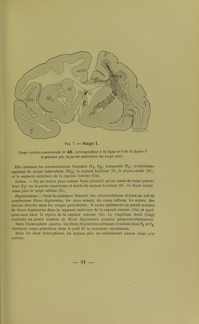 Coupe vertico-transversale n» 48, correspondant à la ligne nn 3 de la figure 3 et passant par la partie antérieure du corps strié. Elle intéresse les circonvolutions frontales (Fj, F2), temporale (Tj), le troisième segment du noyau lenticulaire (NL3), le septum Iucidum (SI), le noyau caudé (NC), et le segment antérieur de la capsule interne (Cia). Lésion. — On ne trouve plus comme foyer primitif, qu’un amas de corps granu- leux (Fp) sur la partie supérieure et droite du septum Iucidum (SI). Ce foyer n’inté resse plus le corps calleux (Ce). Dé générations.— Dans la substance blanche des circonvolutions droites,on voit de nombreuses fibres dégénérées, les unes venant du corps calleux, les autres, des lésions décrites dans les coupes précédentes. Il existe également un grand nombre de fibres dégénérées dans le segment antérieur de la capsule interne (Cia) et quel- ques-unes dans la région de la capsule externe (Ce). Le cingulum droit (Cing) renferme un grand nombre de fibres dégénérées coupées perpendiculairement. Dans l'hémisphère gauche, les fibres dégénérées calleuses irradient dans Fj et F2, Quelques corps granuleux dans le pied de la couronne rayonnante. Dans les deux hémisphères, les noyaux gris ne contiennent aucun corps gra- nuleux. — 91 —
