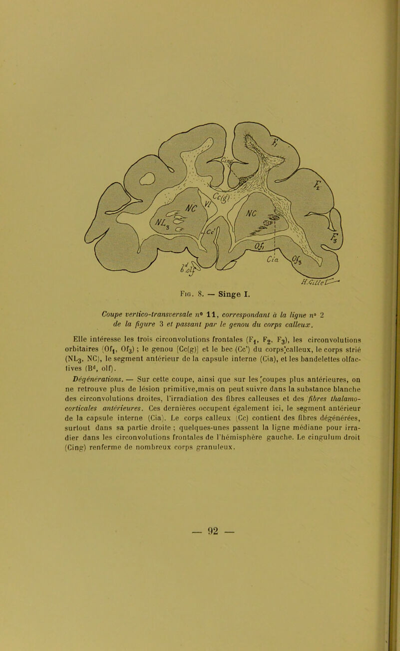 de la figure 3 et passant par le genou du corps calleux. Elle intéresse les trois circonvolutions frontales (Fj, F2, F3), les circonvolutions orbitaires (Ofj, 0f3) ; le genou [Cc(g)J et le bec (Ce’) du corps(calleux, le corps strié (NL3, NC), le segment antérieur de la capsule interne (Cia), et les bandelettes olfac- tives (Bd, olf). Dégénérations.— Sur cette coupe, ainsi que sur les (coupes plus antérieures, on ne retrouve plus de lésion primitive,mais on peut suivre dans la substance blanche des circonvolutions droites, l’irradiation des fibres calleuses et des fibres tlialamo- corticales antérieures. Ces dernières occupent également ici, le segment antérieur de la capsule interne (Cia). Le corps calleux (Ce) contient des fibres dégénérées, surtout dans sa partie droite ; quelques-unes passent la ligne médiane pour irra- dier dans les circonvolutions frontales de l’hémisphère gauche. Le cingulum droit (Cing) renferme de nombreux corps granuleux. — 1)2
