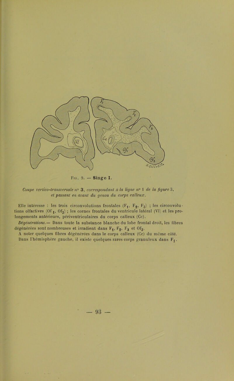 Coupe verlico-lransversate n° 3, correspondant à la ligne n° 1 de la figure 3, et passant en avant du genou du corps calleux. Elle intéresse : les trois circonvolutions frontales (Fj, F2, F3) ; les circonvolu- tions olfactives (Of 0f3) ; les cornes frontales du ventricule latéral (VI) et les pro- longements antérieurs, périventriculaires du corps calleux (Ce). Dégénérations.— Dans toute la substance blanche du lobe frontal droit, les fibres dégénérées sont nombreuses et irradient dans Fj, F2, F3 et 0f3. A noter quelques fibres dégénérées dans le corps calleux (Ce) du même côté. Dans l’hémisphère gauche, il existe quelques rares corps granuleux dans Fj.