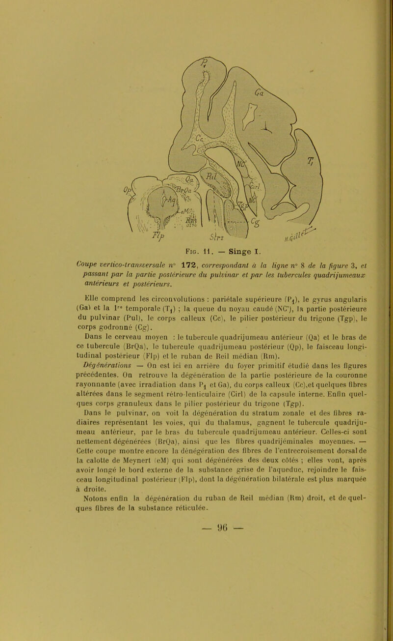 Coupe ver lico-lransoersale n° 172, correspondant à la ligne n° 8 de la figure 3, et passant par la partie postérieure du pulvinar et par les tubercules quadrijumeaux antérieurs et postérieurs. Klle comprend les circonvolutions : pariétale supérieure (P^), le gyrus angularis (Gai et la 1” temporale (Tj) ; la queue du noyau caudé (NC’), la partie postérieure du pulvinar (Pul), le corps calleux (Ce), le pilier postérieur du trigone (Tgp), le corps godronné (Cg). Dans le cerveau moyen : le tubercule quadrijumeau antérieur (Qa) et le bras de ce tubercule (BrQa), le tubercule quadrijumeau postérieur (Qp), le faisceau longi- tudinal postérieur (Flp) et le ruban de Reil médian (Rm). Dégénéralions — On est ici en arrière du foyer primitif étudié dans les figures précédentes. On retrouve la dégénération de la partie postérieure de la couronne rayonnante (avec irradiation dans etGa), du corps calleux (Ce),et quelques libres altérées dans le segment rétro-lenticulaire (Cirl) de la capsule interne. Enfin quel- ques corps granuleux dans le pilier postérieur du trigone (Tgp). Dans le pulvinar, on voit la dégénération du stratum zonale et des fibres ra- diaires représentant les voies, qui du thalamus, gagnent le tubercule quadriju- meau antérieur, par le bras du tubercule quadrijumeau antérieur. Celles-ci sont nettement dégénérées (BrQa), ainsi que les libres quadrijéminales moyennes. — Celte coupe montre encore la dénégération des libres de l’entrecroisement dorsalde la calotte de Meynert leM) qui sont dégénérées des deux côtés ; elles vont, après avoir longé le bord externe de la substance grise de l'aqueduc, rejoindre le fais- ceau longitudinal poslérieur (Flp), dont la dégénération bilatérale est plus marquée ii droite. Notons enfin la dégônération du ruban de Reil médian (Rm) droit, et de quel- ques fibres de la substance réticulée.