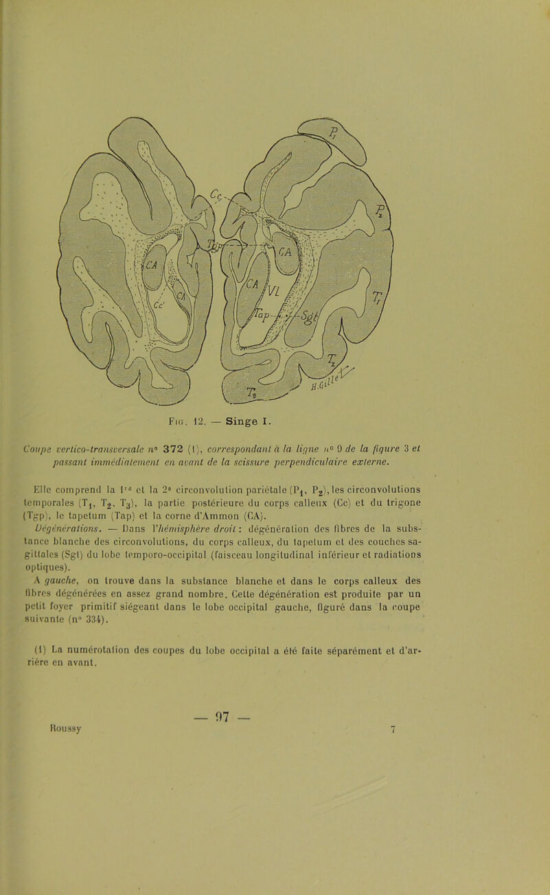 Coupe verlico-transversale n° 372 (1), correspondant à la ligne n° 9 de la figure 3 cl passant immédiatement en avant de la scissure perpendiculaire externe. Elle comprend la lra el la 2a circonvolution pariétale (Pj, P2), les circonvolutions temporales (Tj, T2, T3), la partie postérieure du corps calleux (Ce) et du trigone (Tgp), le tapétum (Tap) et la corne d'Ammon (CA). Dégénéra lions. — Dons l’hémisphère droit : dégénéralion des fibres de la subs- tance blanche des circonvolutions, du corps calleux, du tapétum et des couches sa- gittales (Sgi) du lobe (emporo-oceipital (faisceau longitudinal inférieur el radiations optiques). A gauche, on trouve dans la substance blanche et dans le corps calleux des fibres dégénérées en assez grand nombre. Cette dégénération est produite par un petit foyer primitif siégeant dans le lobe occipital gauche, figuré dans la coupe suivante (n° 334). (1) La numérotation des coupes du lobe occipital a été faite séparément et d’ar- rière en avant. Roussy — fl7 -