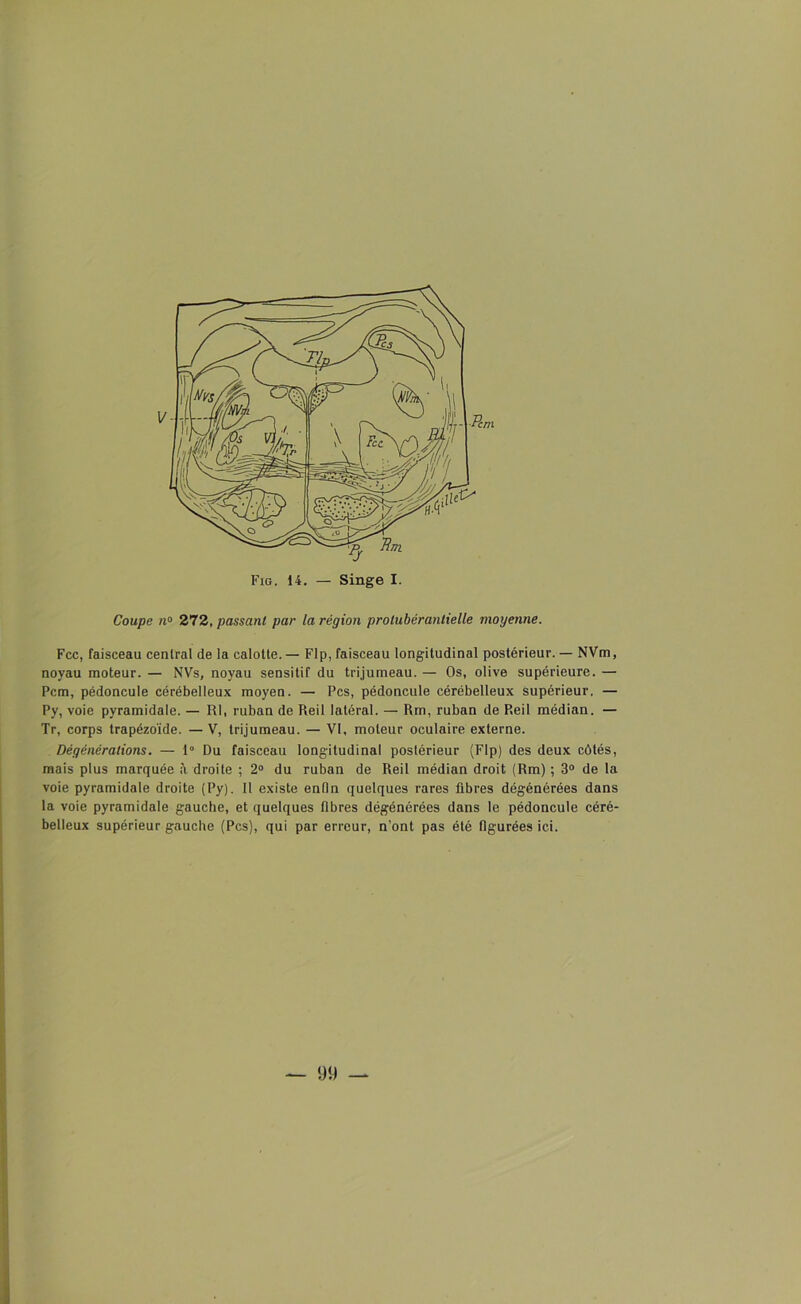 Coupe na 272, passant par la région prolubérantielle moyenne. Fcc, faisceau central de la calotte.— Flp, faisceau longitudinal postérieur. — NVm, noyau moteur. — NVs, noyau sensitif du trijumeau. — Os, olive supérieure. — Pcm, pédoncule cérébelleux moyen. — Pcs, pédoncule cérébelleux supérieur. — Py, voie pyramidale. — RI, ruban de Reil latéral. — Rm, ruban de P.eil médian. — Tr, corps trapézoïde. — V, trijumeau. — VI, moteur oculaire externe. Dégénérations. — 1° Du faisceau longitudinal postérieur (Flp) des deux côtés, mais plus marquée à droite ; 2° du ruban de Reil médian droit (Rm) ; 3° de la voie pyramidale droite (Py). Il existe enfin quelques rares fibres dégénérées dans la voie pyramidale gauche, et quelques fibres dégénérées dans le pédoncule céré- belleux supérieur gauche (Pcs), qui par erreur, n’ont pas été figurées ici.