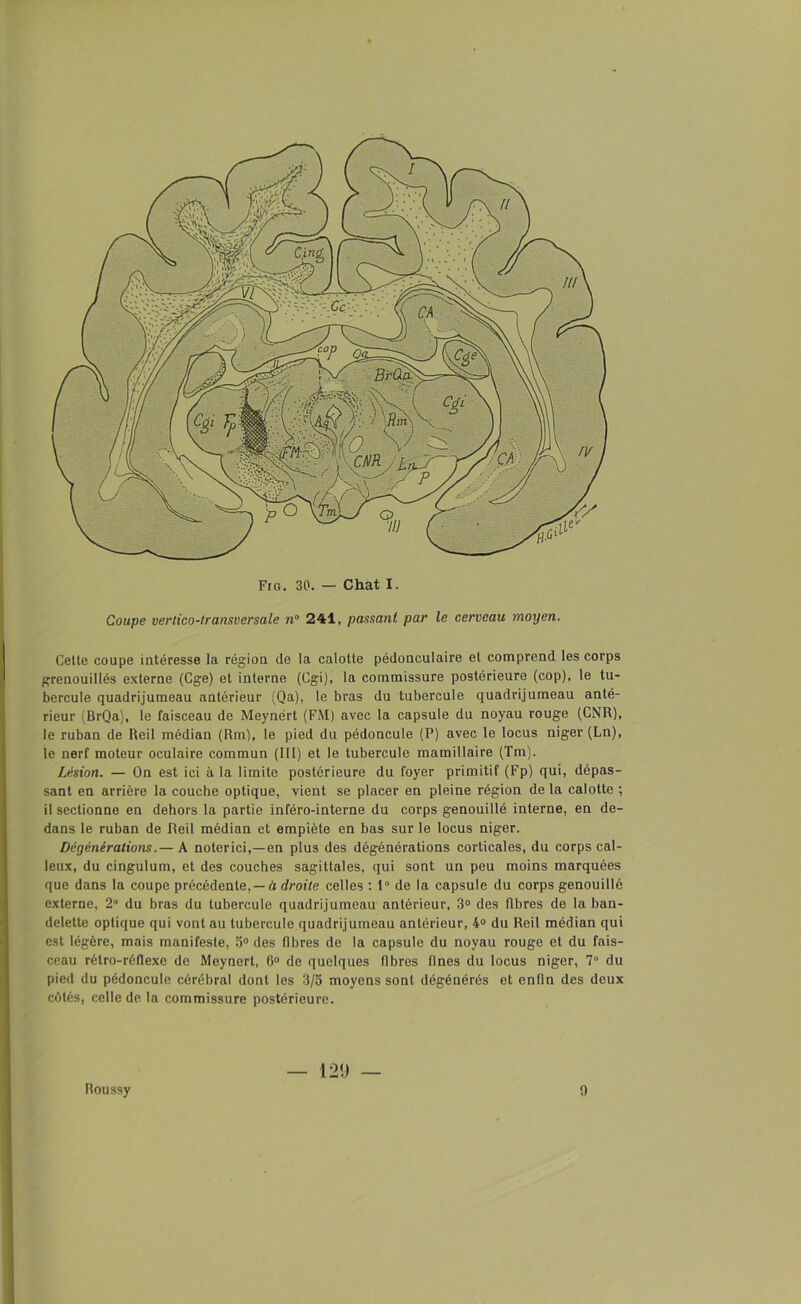 Coupe vertico-transversale n° 241, passant par le cerveau moyen. Celte coupe intéresse la région de la calotte pédonculaire et comprend les corps grenouillés externe (Cge) et interne (Cgi), la commissure postérieure (cop), le tu- bercule quadrijumeau antérieur (Qa), le bras du tubercule quadrijumeau anté- rieur (BrQa), le faisceau de Meynért (FM) avec la capsule du noyau rouge (CNR), le ruban de Reil médian (Rm), le pied du pédoncule (P) avec le locus niger (Ln), le nerf moteur oculaire commun (111) et le tubercule mamillaire (Tm). Lésion. — On est ici à la limite postérieure du foyer primitif (Fp) qui, dépas- sant en arrière la couche optique, vient se placer en pleine région de la calotte ; il sectionne en dehors la partie inféro-interne du corps genouillé interne, en de- dans le ruban de Reil médian et empiète en bas sur le locus niger. Dégénérations.— A noterici,—en plus des dégénérations corticales, du corps cal- leux, du cingulum, et des couches sagittales, qui sont un peu moins marquées que dans la coupe précédente,— à droite celles : 1° de la capsule du corps genouillé externe, 2° du bras du tubercule quadrijumeau antérieur, 3° des fibres de la ban- delette optique qui vont au tubercule quadrijumeau antérieur, 4° du Reil médian qui est légère, mais manifeste, 5° des fibres de la capsule du noyau rouge et du fais- ceau rétro-réflexe de Meynert, 0° de quelques fibres fines du locus niger, 7° du pied du pédoncule cérébral dont les 3/5 moyens sont dégénérés et enfin des deux côtés, celle de la commissure postérieure. Roussy — 120 — o
