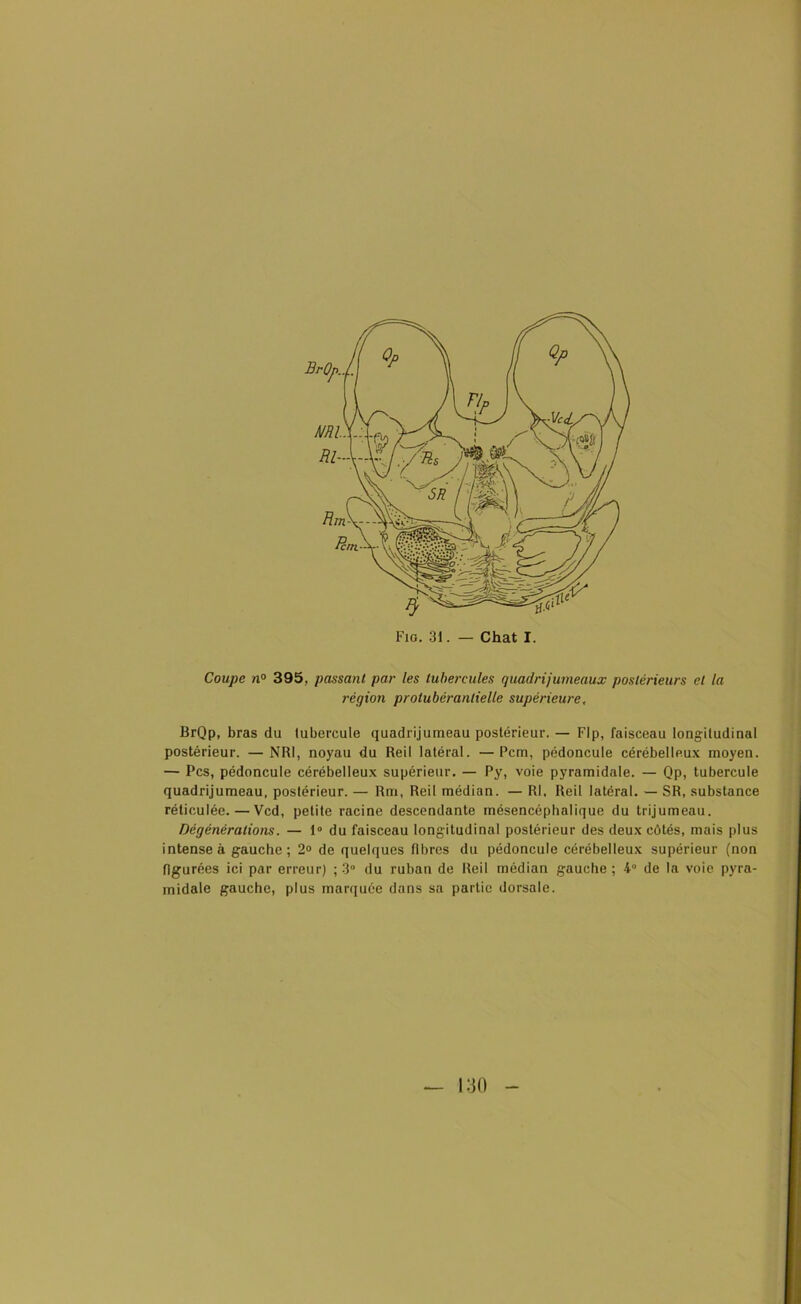 Coupe n° 395, passant par les tubercules quadrijumeaux postérieurs et la région protubérantielle supérieure, BrQp, bras du tubercule quadrijumeau postérieur. — Flp, faisceau longitudinal postérieur. — NR1, noyau du Reil latéral. —Pem, pédoncule cérébelleux moyen. — Pcs, pédoncule cérébelleux supérieur. — Py, voie pyramidale. — Qp, tubercule quadrijumeau, postérieur. — Rm, Reil médian. — RI. Reil latéral. — SR, substance réticulée.—Vcd, petite racine descendante mésencéphalique du trijumeau. Dégénérations. — 1° du faisceau longitudinal postérieur des deux côtés, mais plus intense à gauche ; 2° de quelques fibres du pédoncule cérébelleux supérieur (non figurées ici par erreur) ; 3° du ruban de Reil médian gauche ; 4° de la voie pyra- midale gauche, plus marquée dans sa partie dorsale.