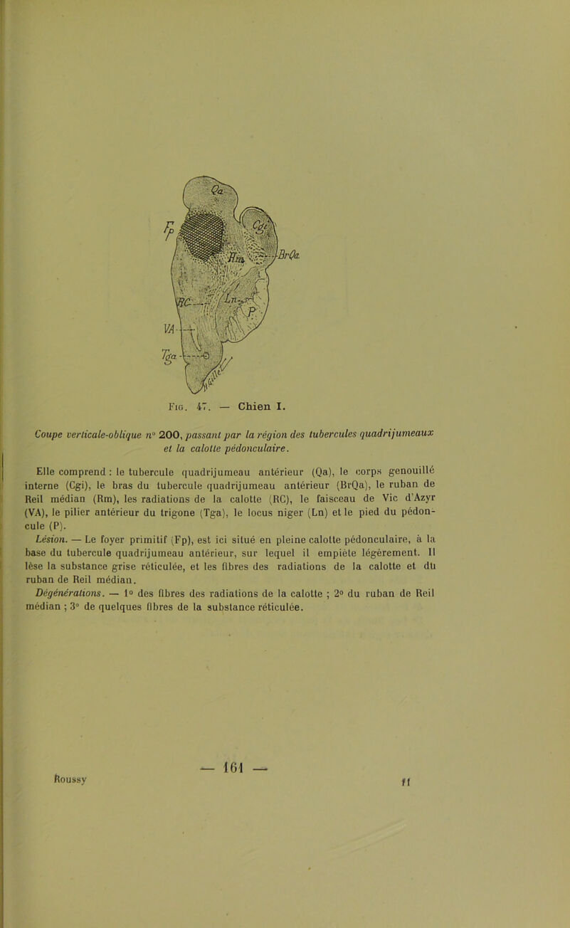 Coupe verticale-oblique ji° 200, passant par la région des tubercules quadrijumeaux et la calotte pédonculaire. Elle comprend : le tubercule quadrijumeau antérieur (Qa), le corps genouillé interne (Cgi), le bras du tubercule quadrijumeau antérieur (BrQa), le ruban de Reil médian (Rm), les radiations de la calotte (RC), le faisceau de Vie d’Azyr (VA), le pilier antérieur du trigone (Tga), le locus niger (Ln) et le pied du pédon- cule (P). Lésion. — Le foyer primitif (Fp), est ici situé en pleine calotte pédonculaire, à la base du tubercule quadrijumeau antérieur, sur lequel il empiète légèrement. Il lèse la substance grise réticulée, et les fibres des radiations de la calotte et dü ruban de Reil médian. Dègénéralions. — 1° des fibres des radiations de la calotte ; 2° du ruban de Reil médian ; 3° de quelques fibres de la substance réticulée. houssy — 161 — tf